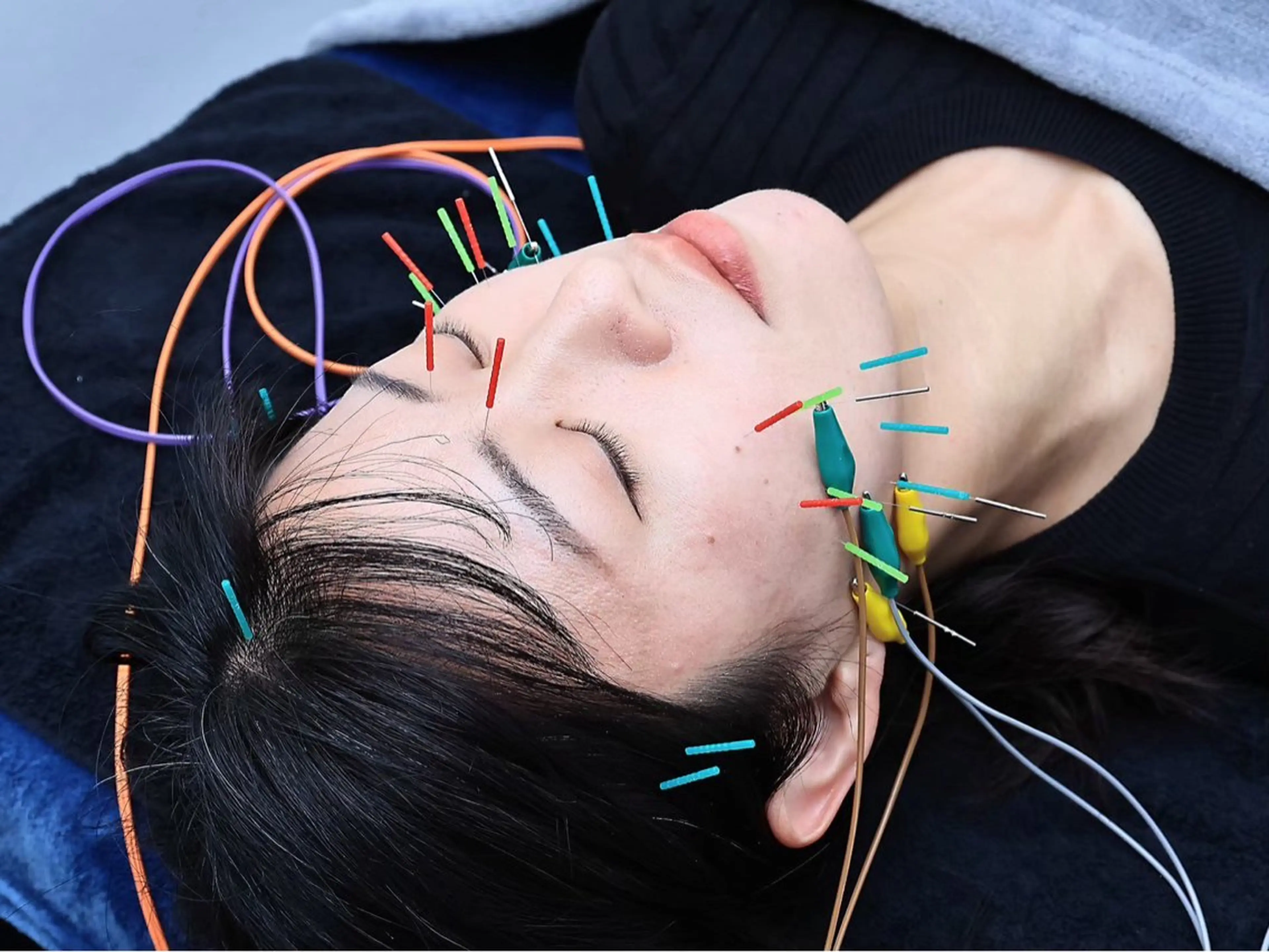 人気No.1✨【たるみ解消/むくみ/美肌/リフトアップ/小顔効果/エラ張り軽減】小顔矯正＋リフトUP美容鍼 60分の写真