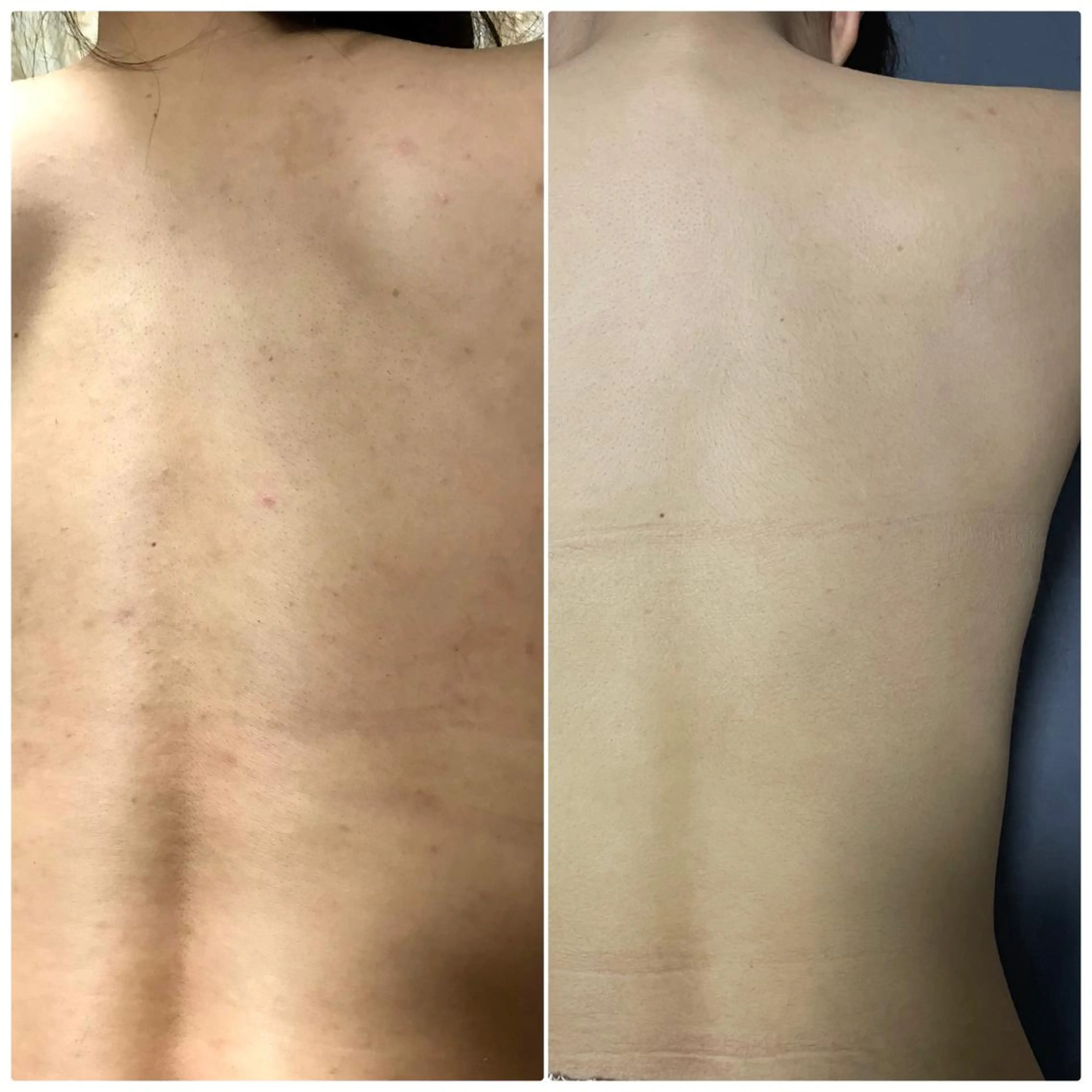 【女性限定】背中美人に肌荒れ改善　背中ゴマージュの写真