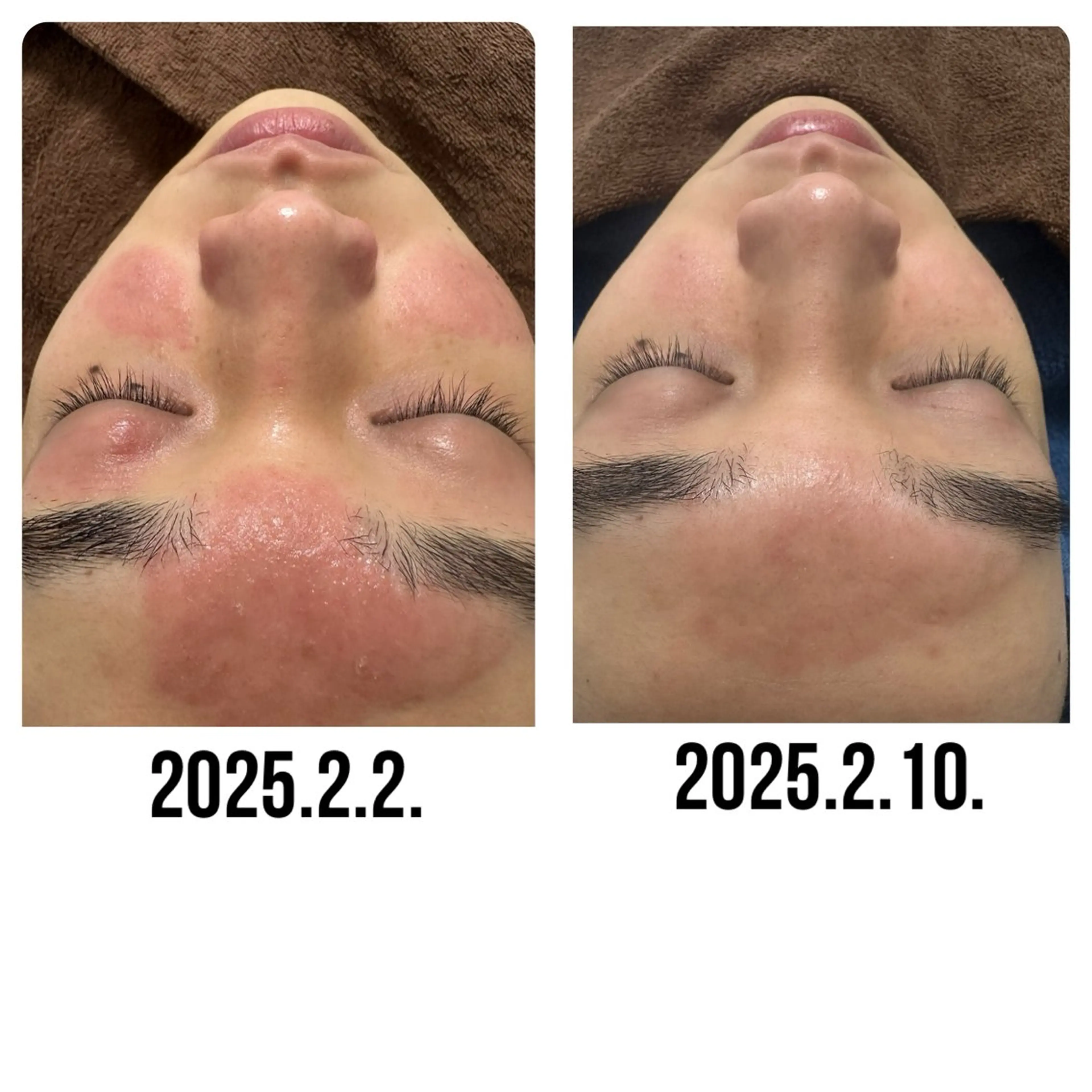 【赤ニキビ改善】 BELL'ET新宿店のエステ・リラクイメージ