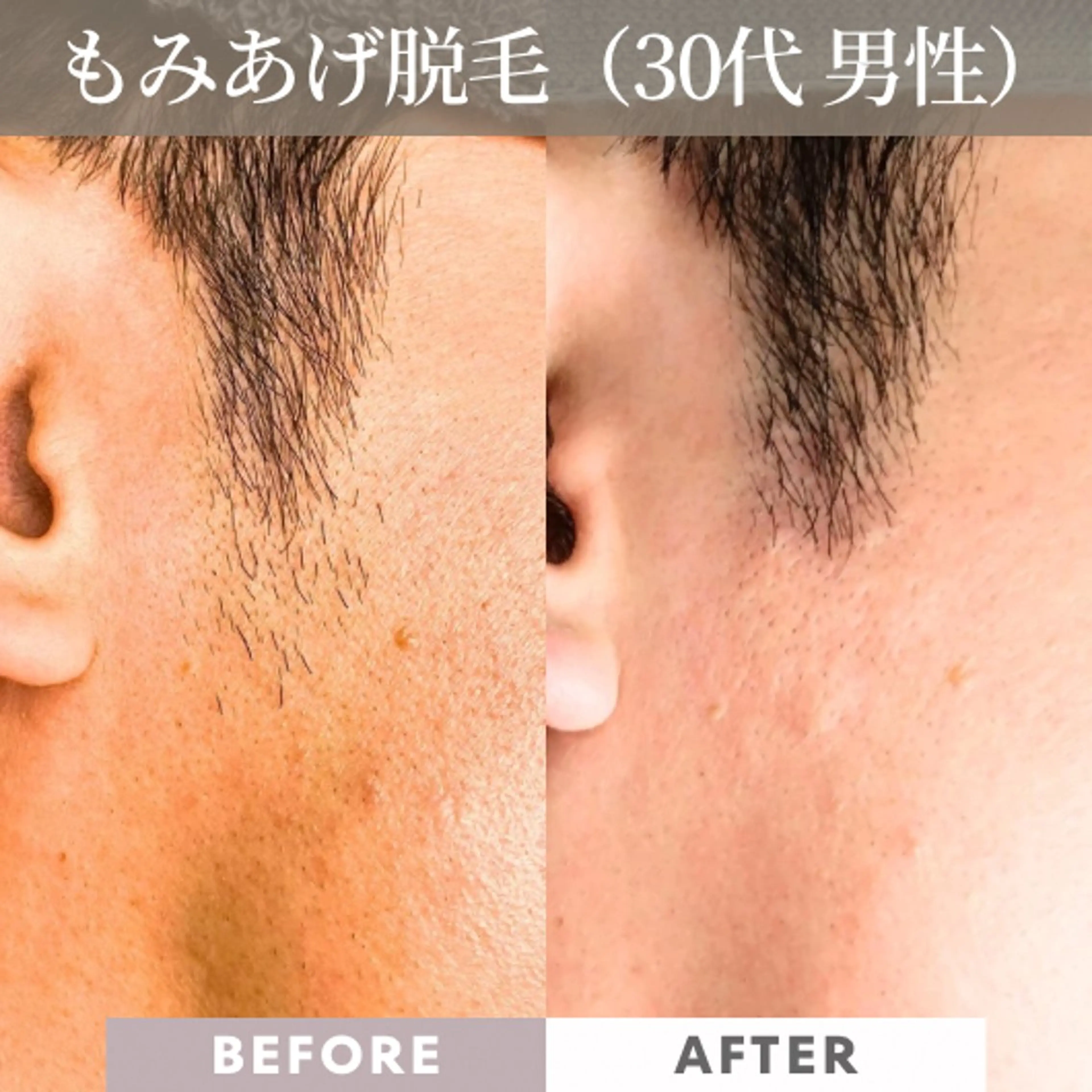 メンズ 【一本ずつ脱毛】 ReMove 柏のエステ・リラクイメージ