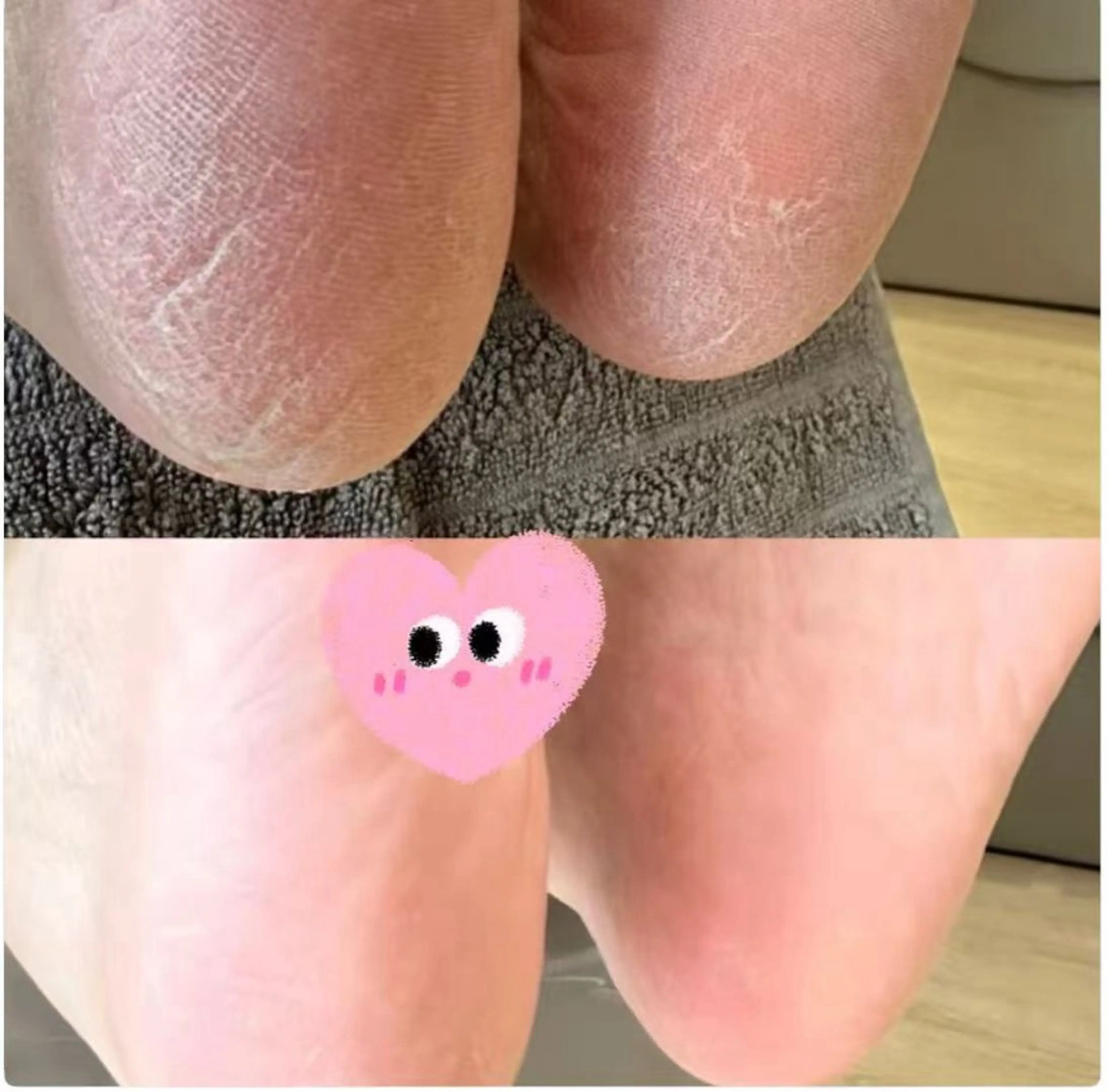 ピーリング除去の写真