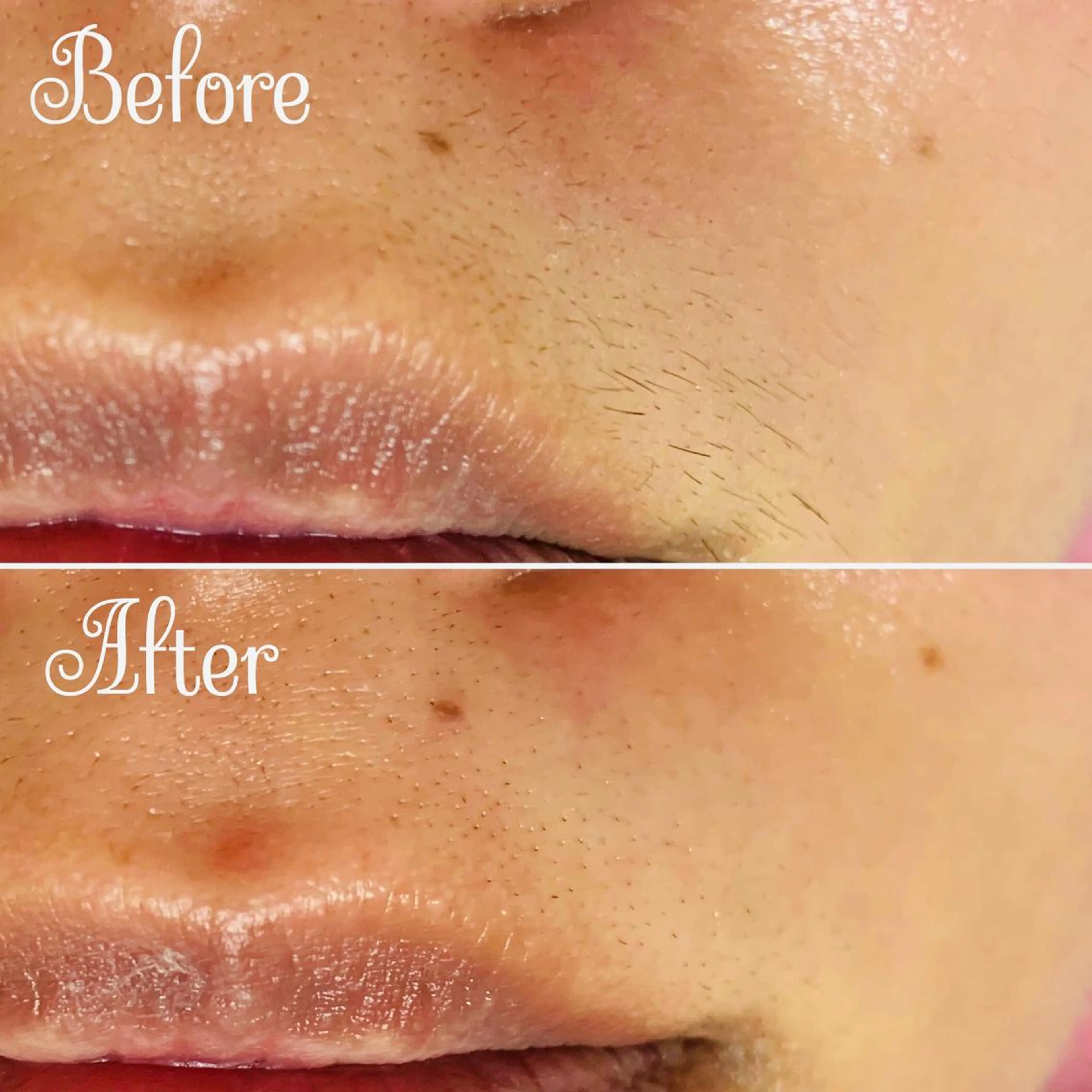 脱毛 Linomalie エステ/たるみ/脱毛のエステ・リラクイメージ