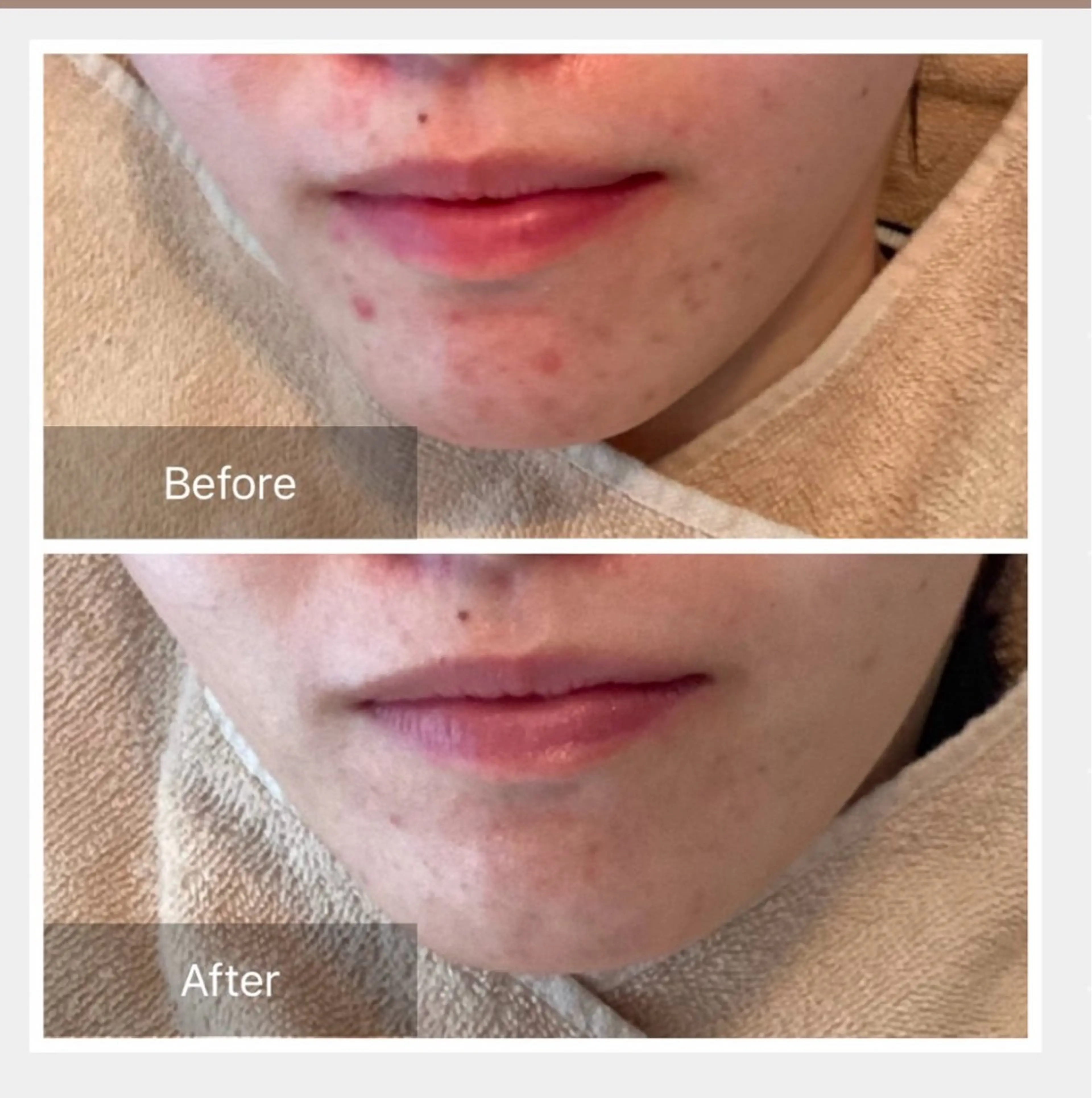 🌿部分的に剥離したいハーブ✨【剥離あり】【毛穴洗浄】【GF美容液】ニキビ/ニキビ跡/黒ずみ/水光肌/毛穴ケアの写真