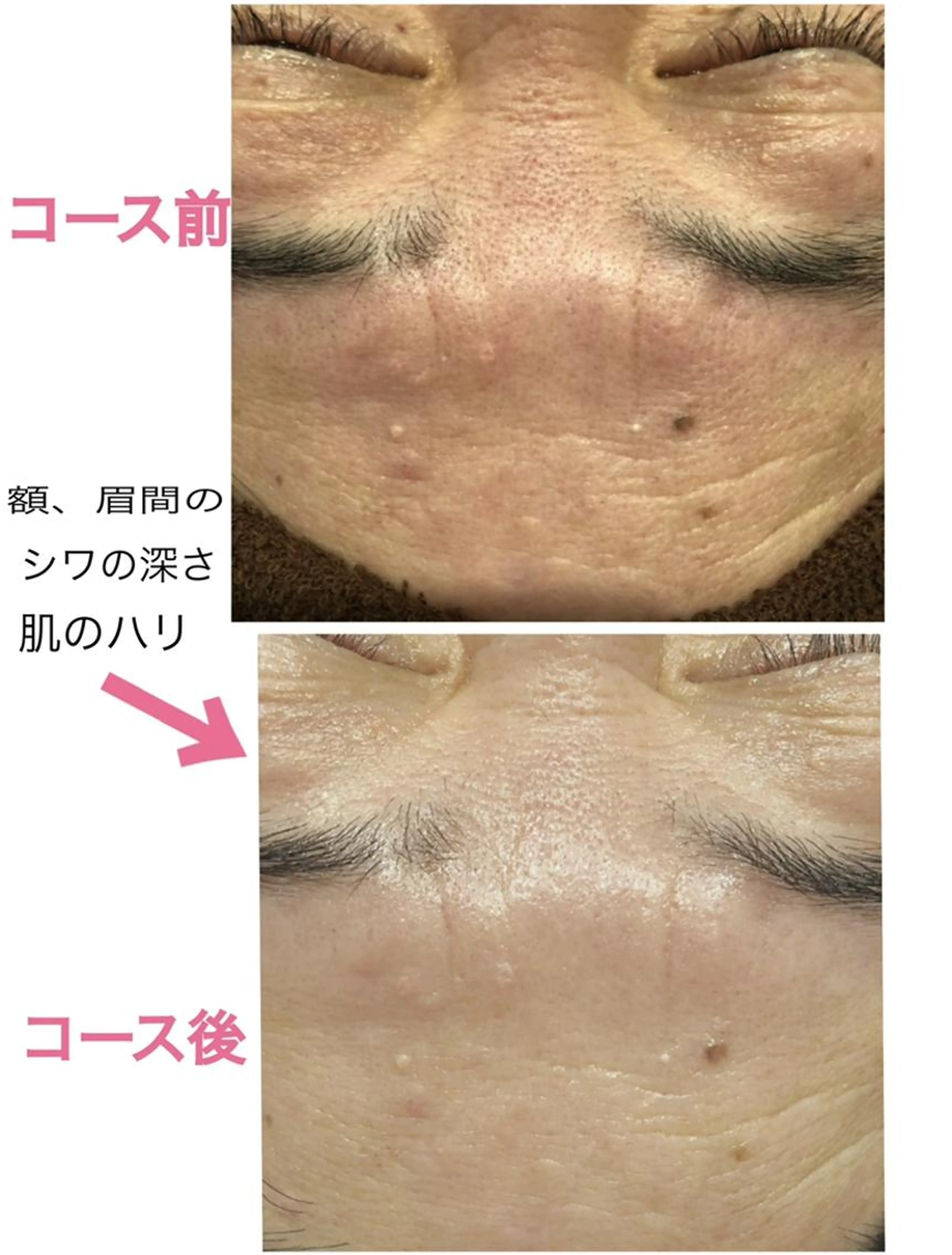 【ダーマメソニードルフェイシャル】✨エステ版✨ダーマペン！痛み/赤み無🙆肌不調には肌深部からの改善を✨の写真