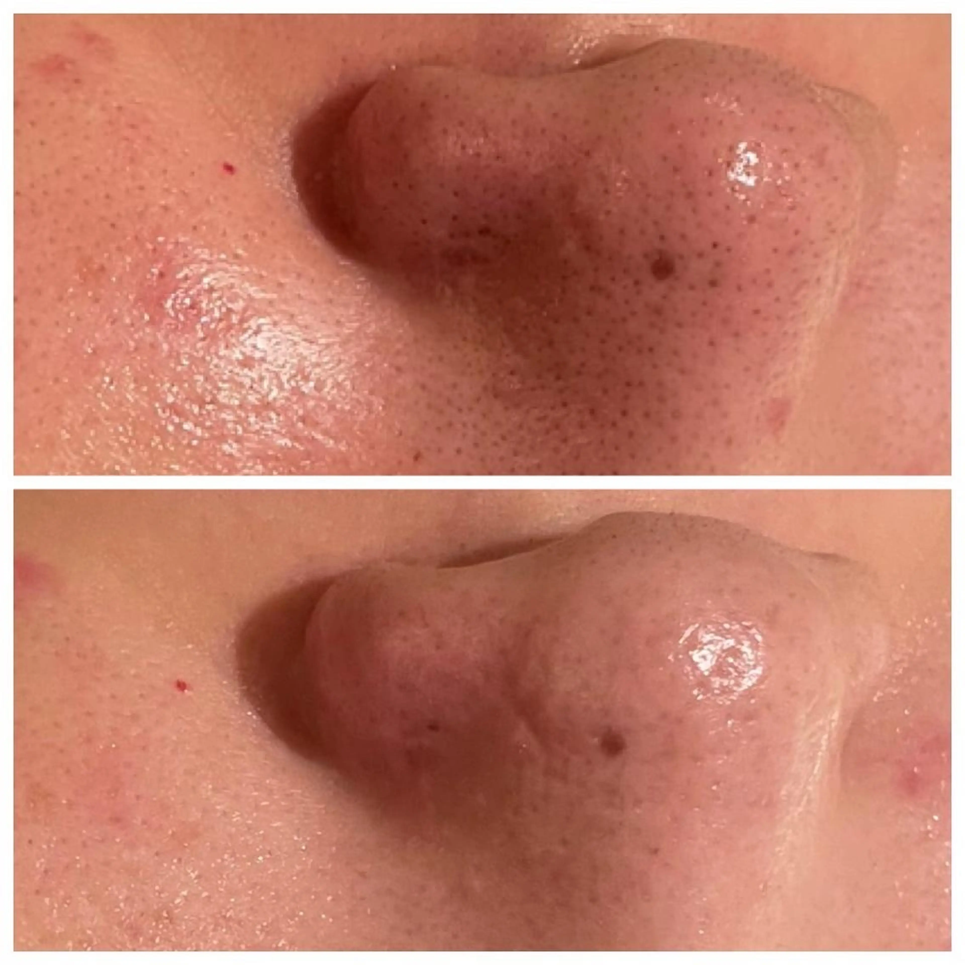 【❤️3.4月限定特別なイベント前に❤️】ツヤ肌を作る✨毛穴洗浄ケア＋生コラーゲン導入＋細胞活性化セルサーの写真