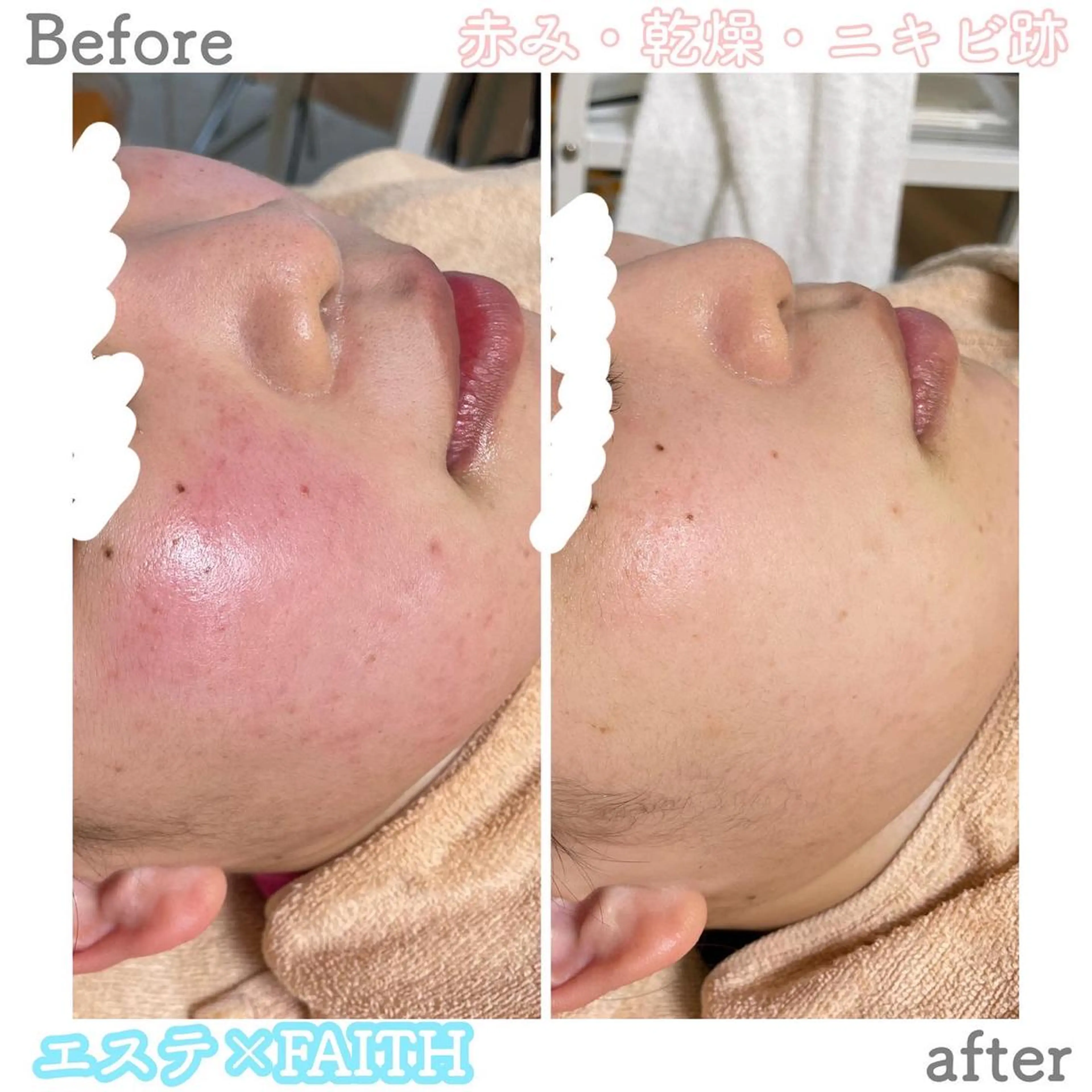 ロング カラー パーマ ヘアアレンジ メンズ キッズ ネイル マツエク・マツパ アイブロウ エステ ニキビ&跡改善サロン オーナー光木のエステ・リラクイメージ