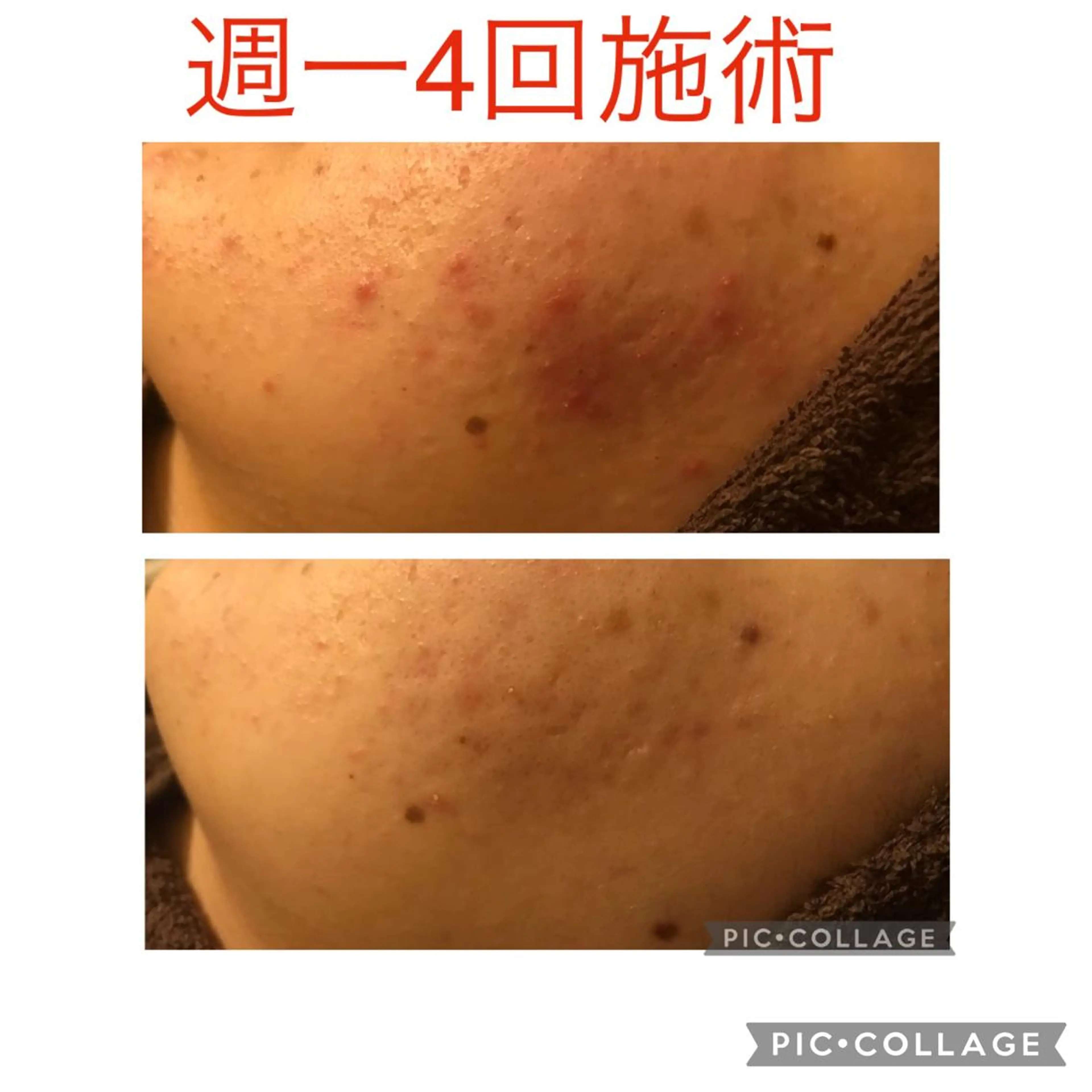 来年の夏は美しい背中へ✨背中の肌荒れケアコース☀️(背中全面)120分の写真