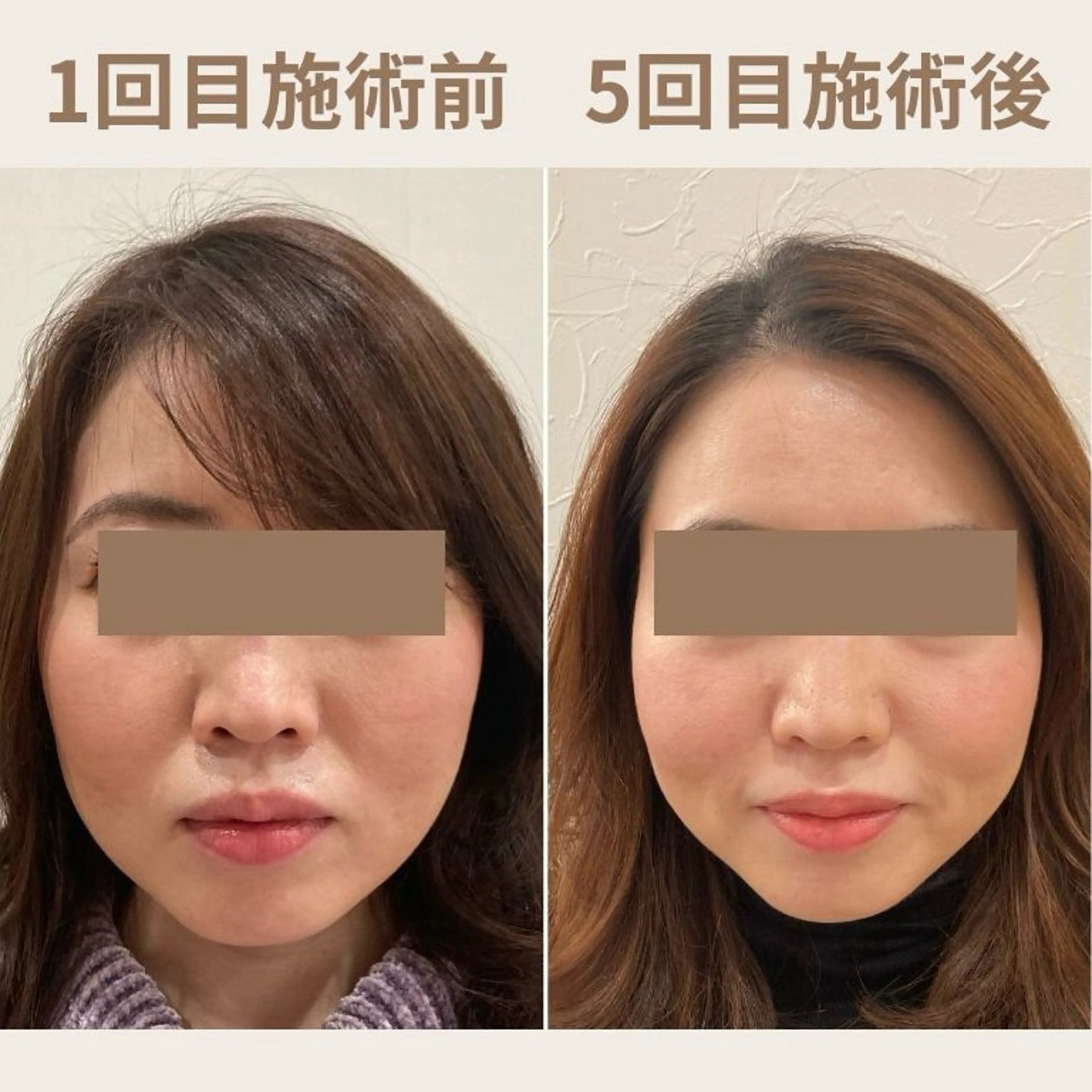 《人気No.1》迷ったらコレ❣️お顔も体もまとめてスッキリ✨【電気美容鍼】90分 ￥13,200 → ￥4,900の写真