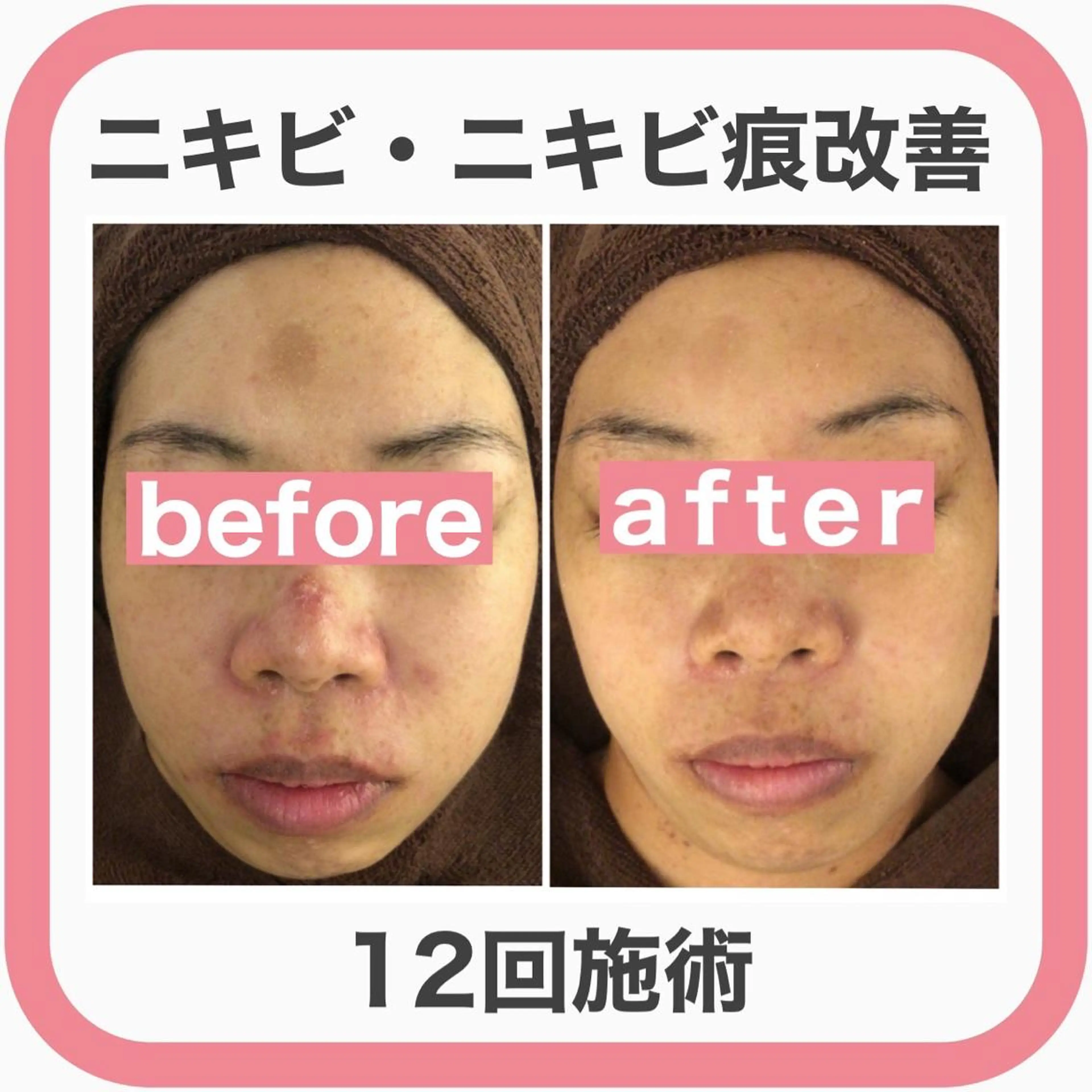 セミロング カラー パーマ ヘアアレンジ メンズ キッズ ネイル マツエク・マツパ アイブロウ 3か月で肌革命👼 ニキビ専門店💫のエステ・リラクイメージ