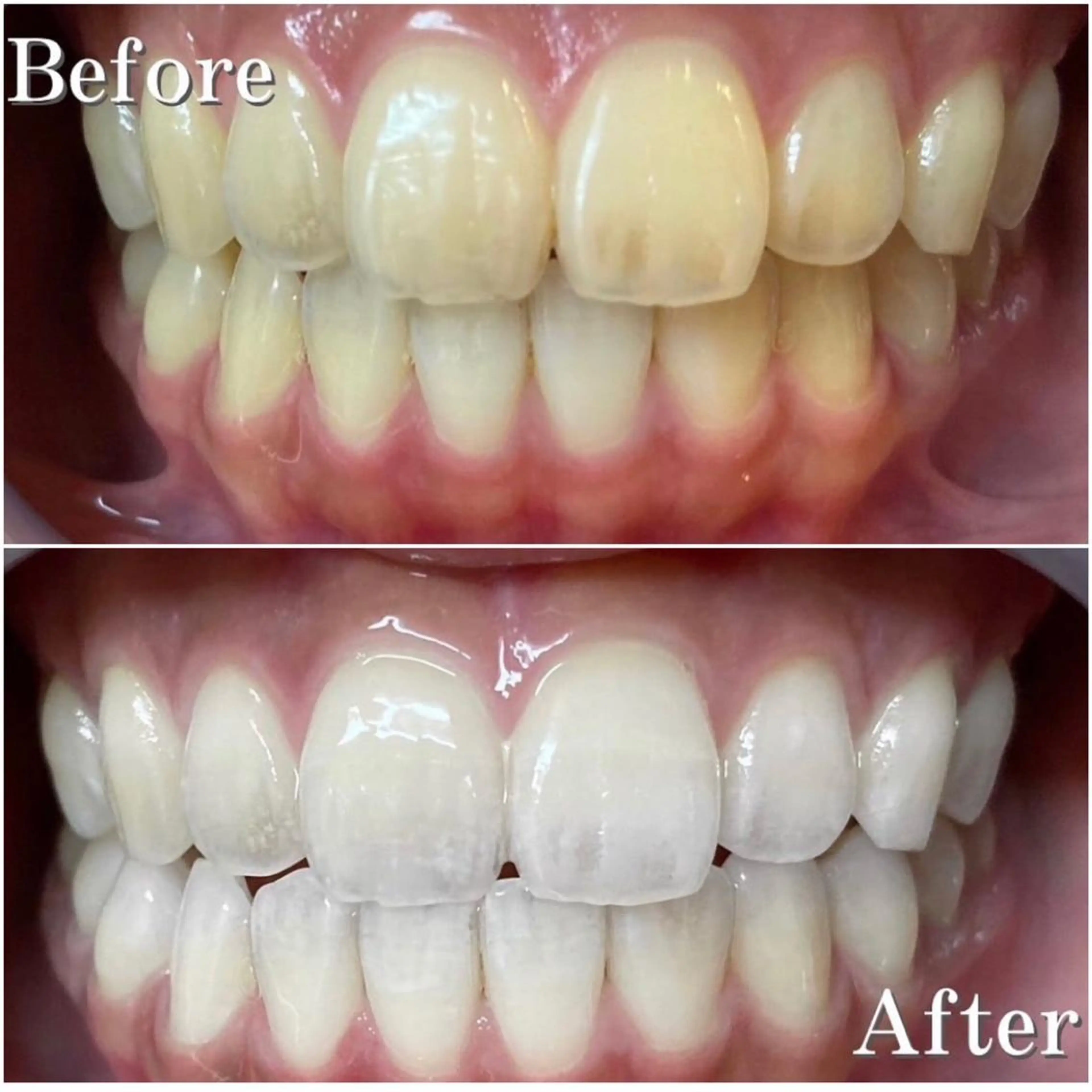 その他 LBSホワイトニング 🌸梅田店公式のその他イメージ