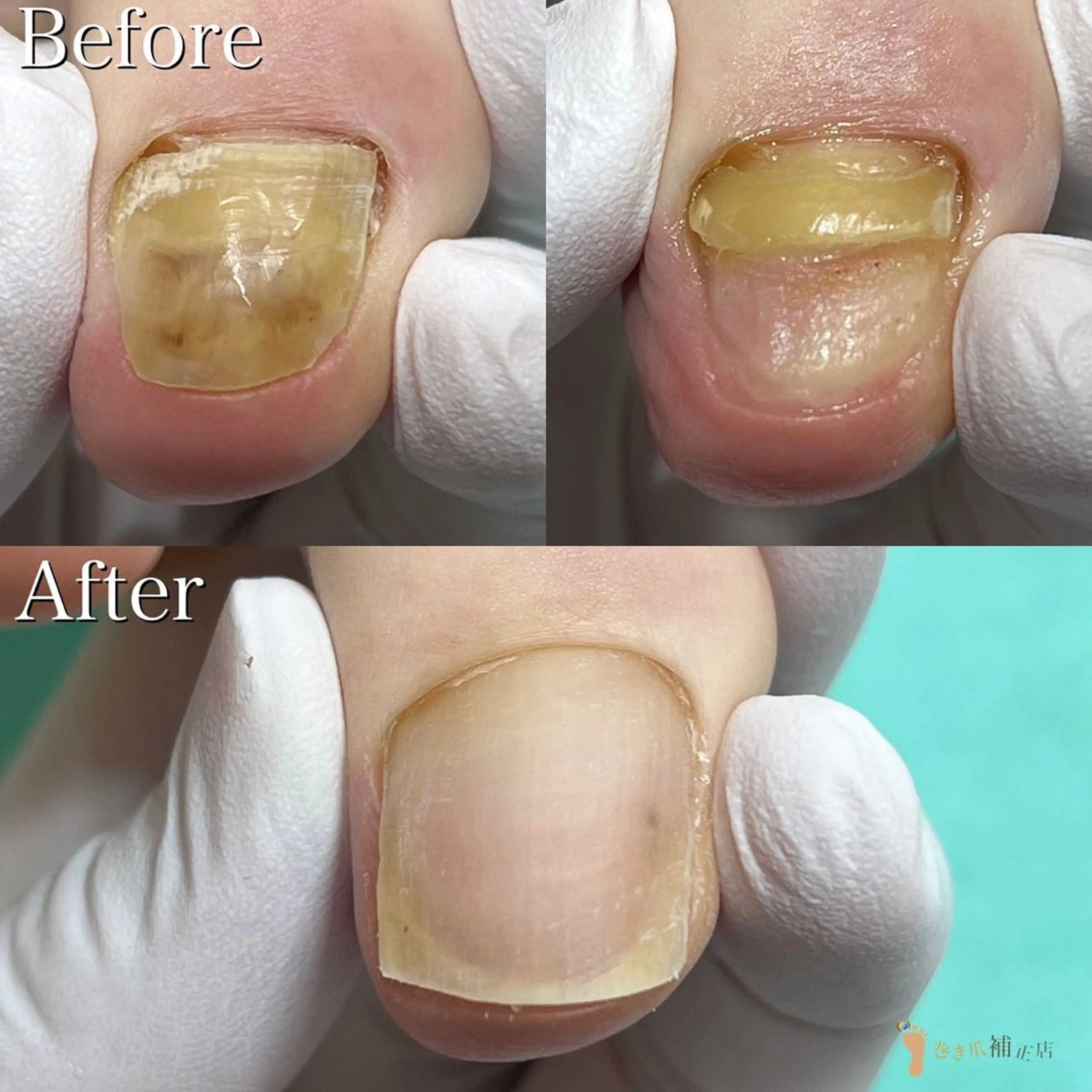 【変形爪再生】変形、変色が強い方‼️ぶつけたりしてから爪が伸びない方⚠️諦めないでください！の写真