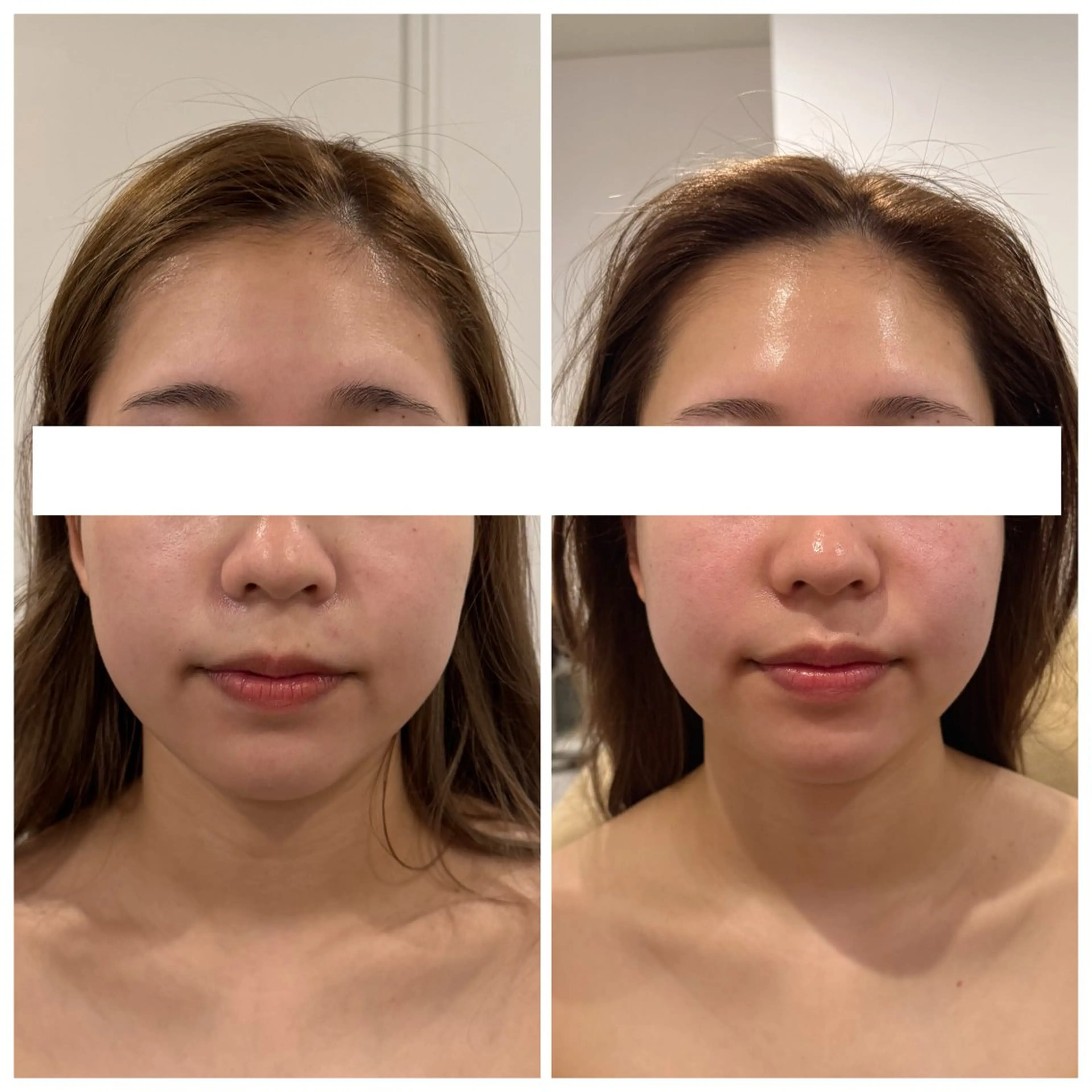 👑小顔ケアNo.1✨本格コルギで瞬間小顔リセット🤍輪郭デザイン💫コルギ&ハイパーナイフEXで小顔へchange💖の写真