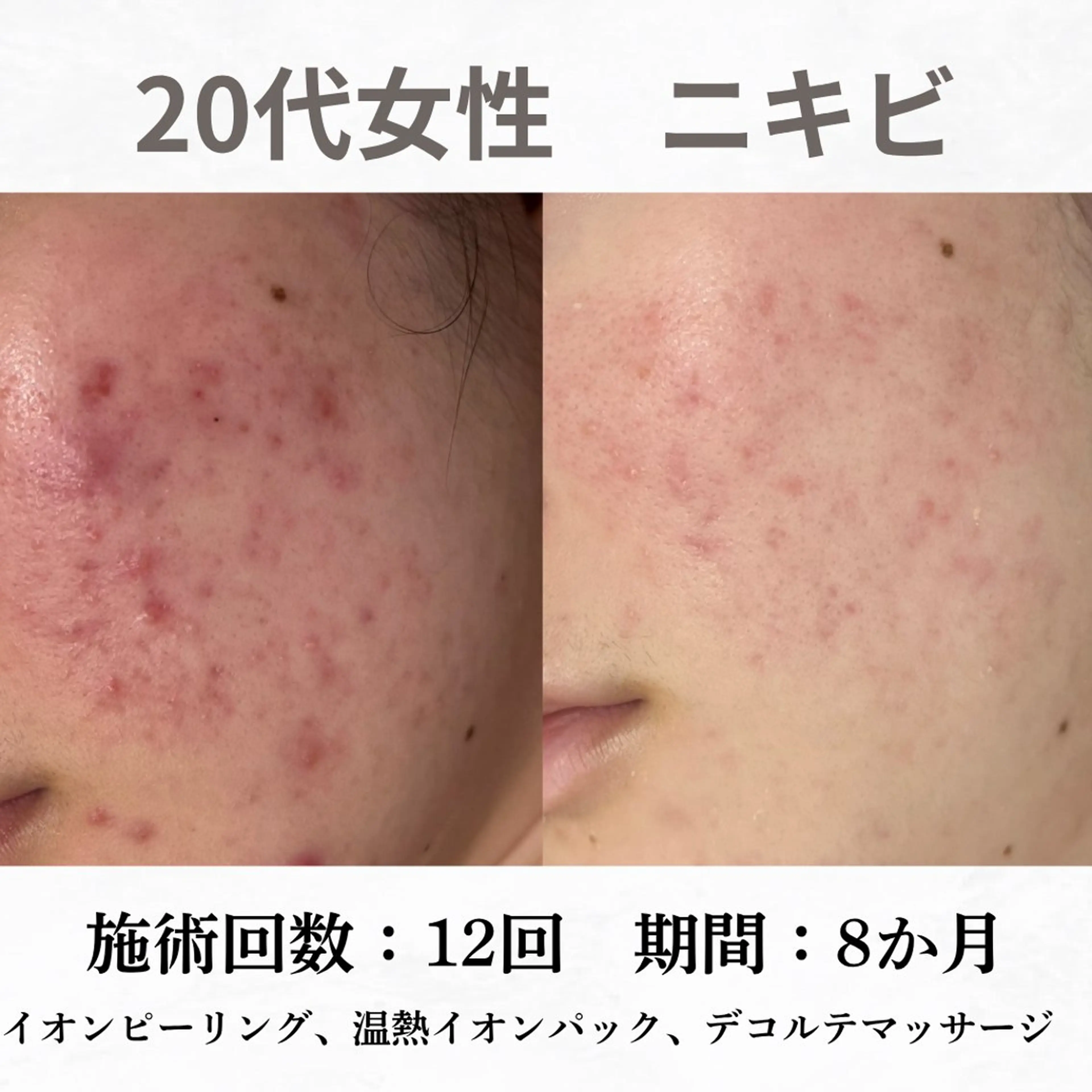 重度ニキビ専門🌷 ダウンタイムなしのエステ・リラクイメージ