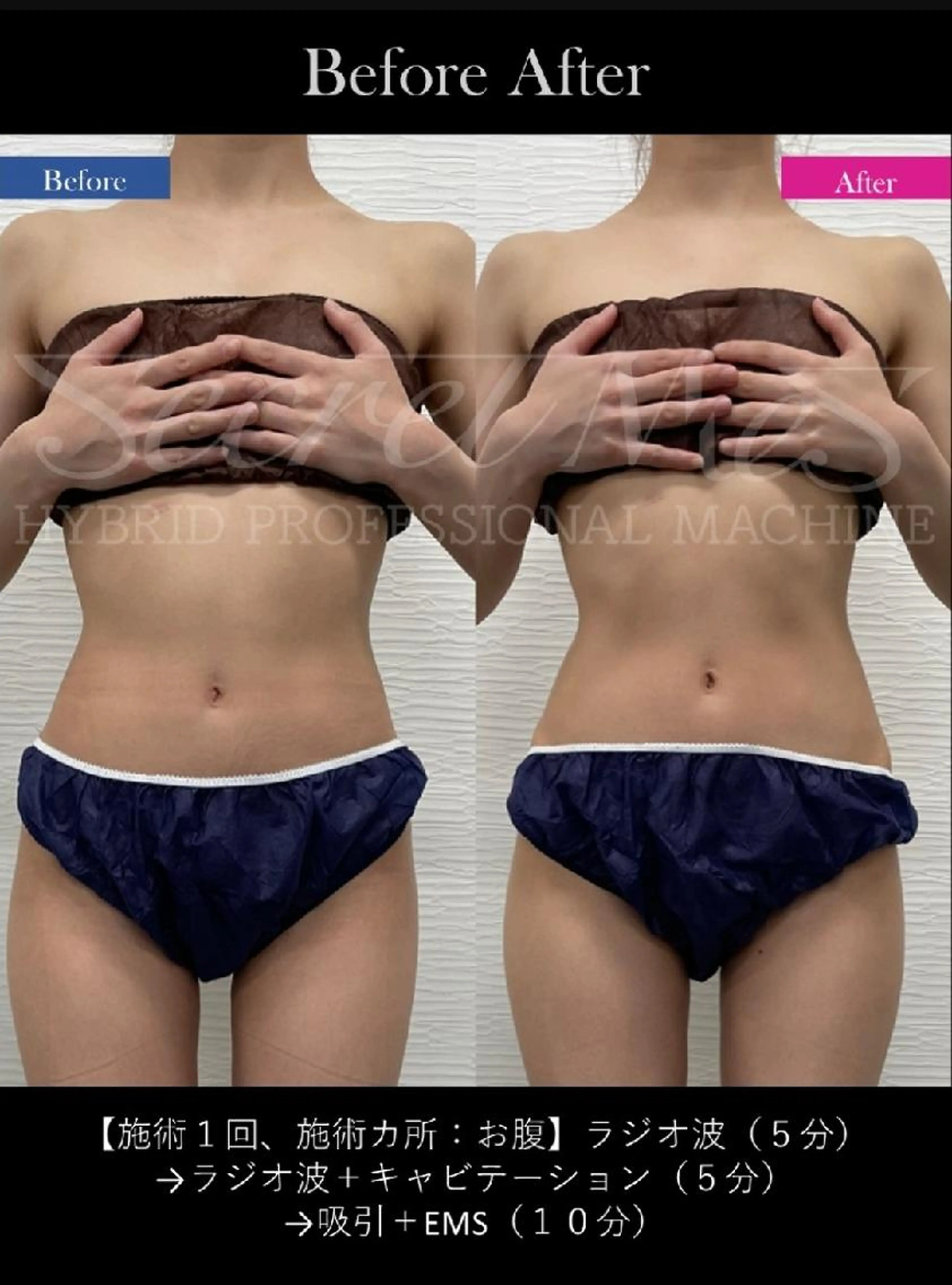 綺麗応援♥　プロ用シークレットメスマシンセルフエステの写真