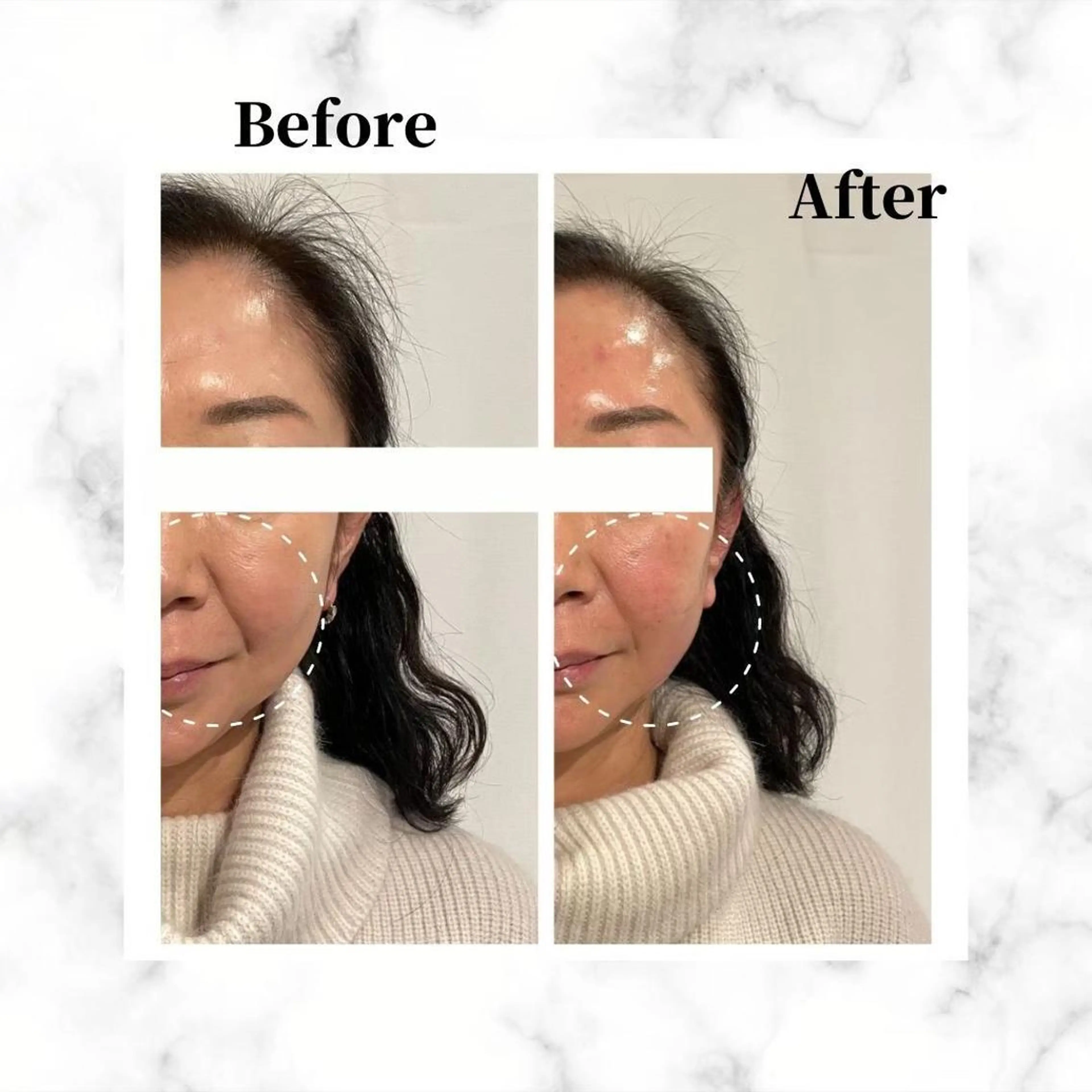 12Dハイフ💗 最強小顔のエステ・リラクイメージ