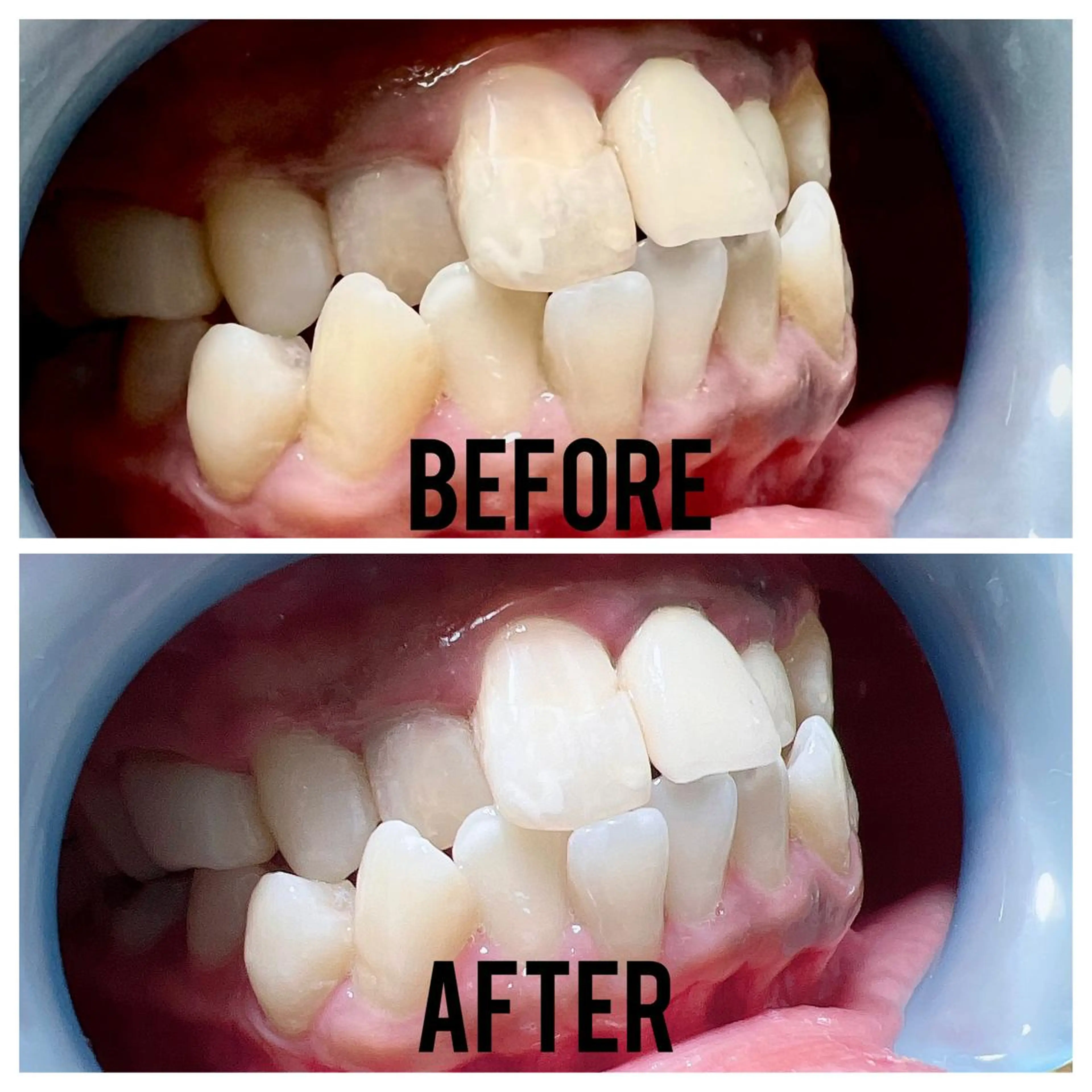 セルフホワイトニングの写真