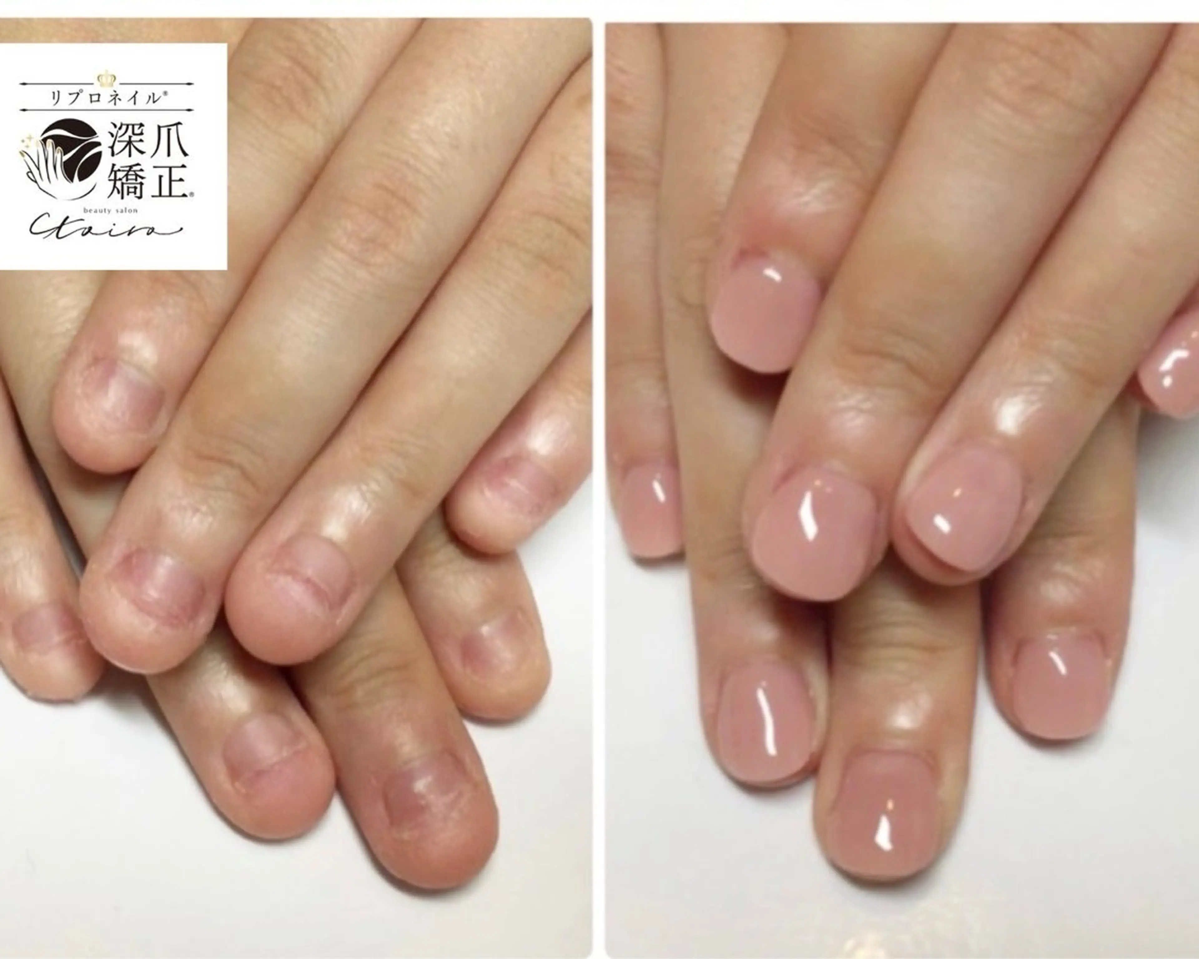 メンズ ネイル フットネイル 深爪矯正専門店　ネイルサロン　トイロ所属・ネイルサロン トイロのネイルデザイン