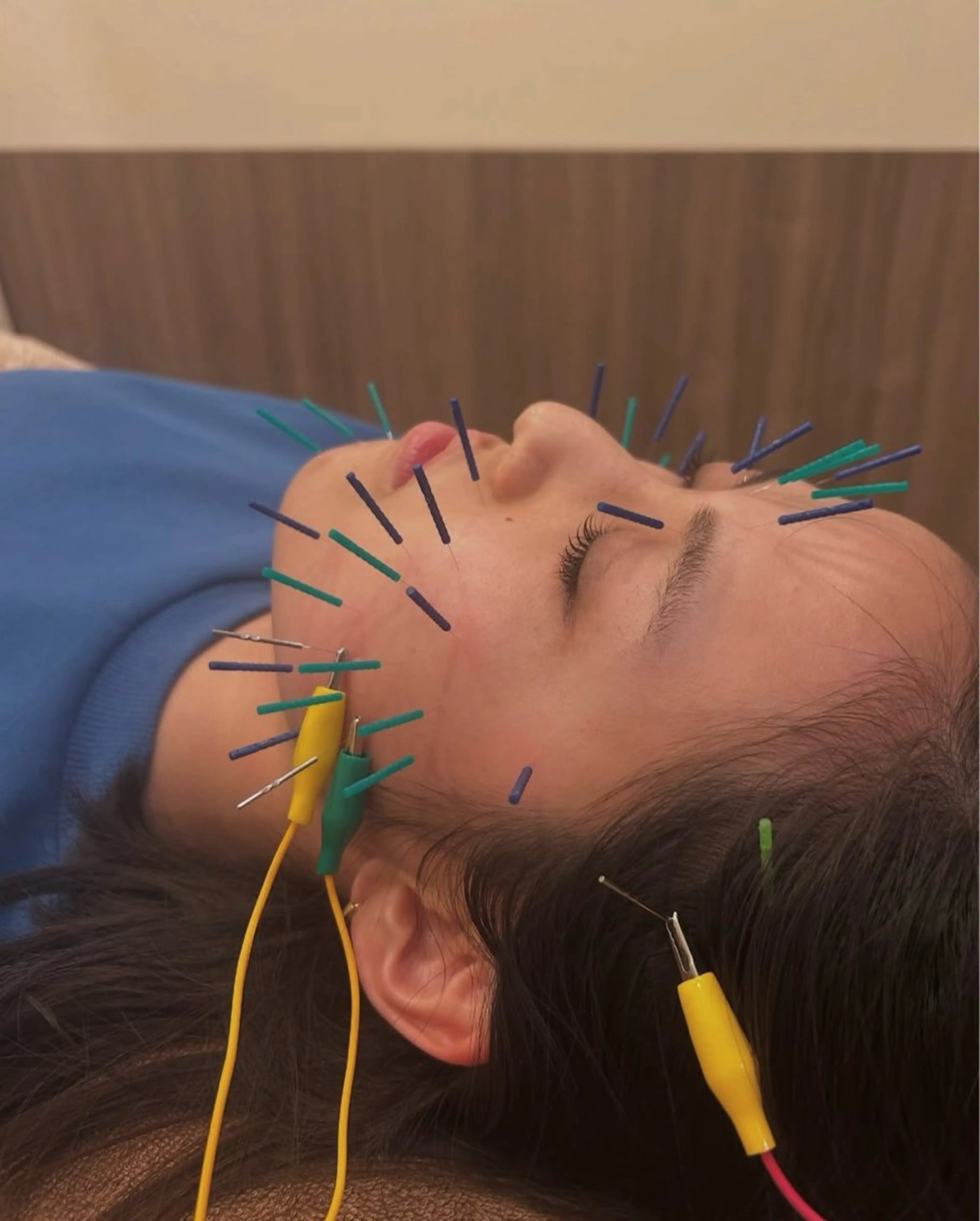 🪡🇰🇷Special美容鍼✖️LHALA PEEL:ララピールの写真