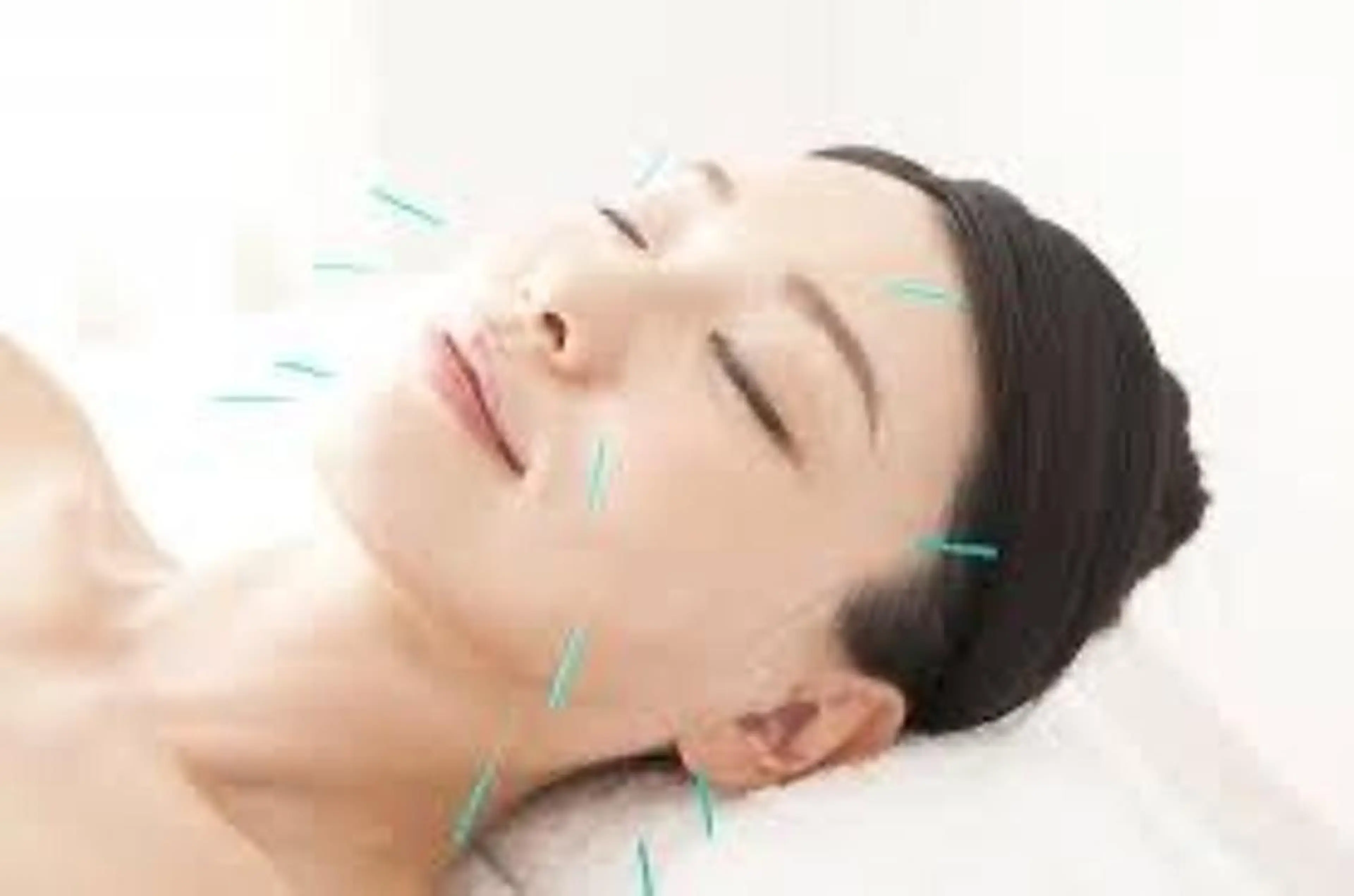 美容鍼　の写真