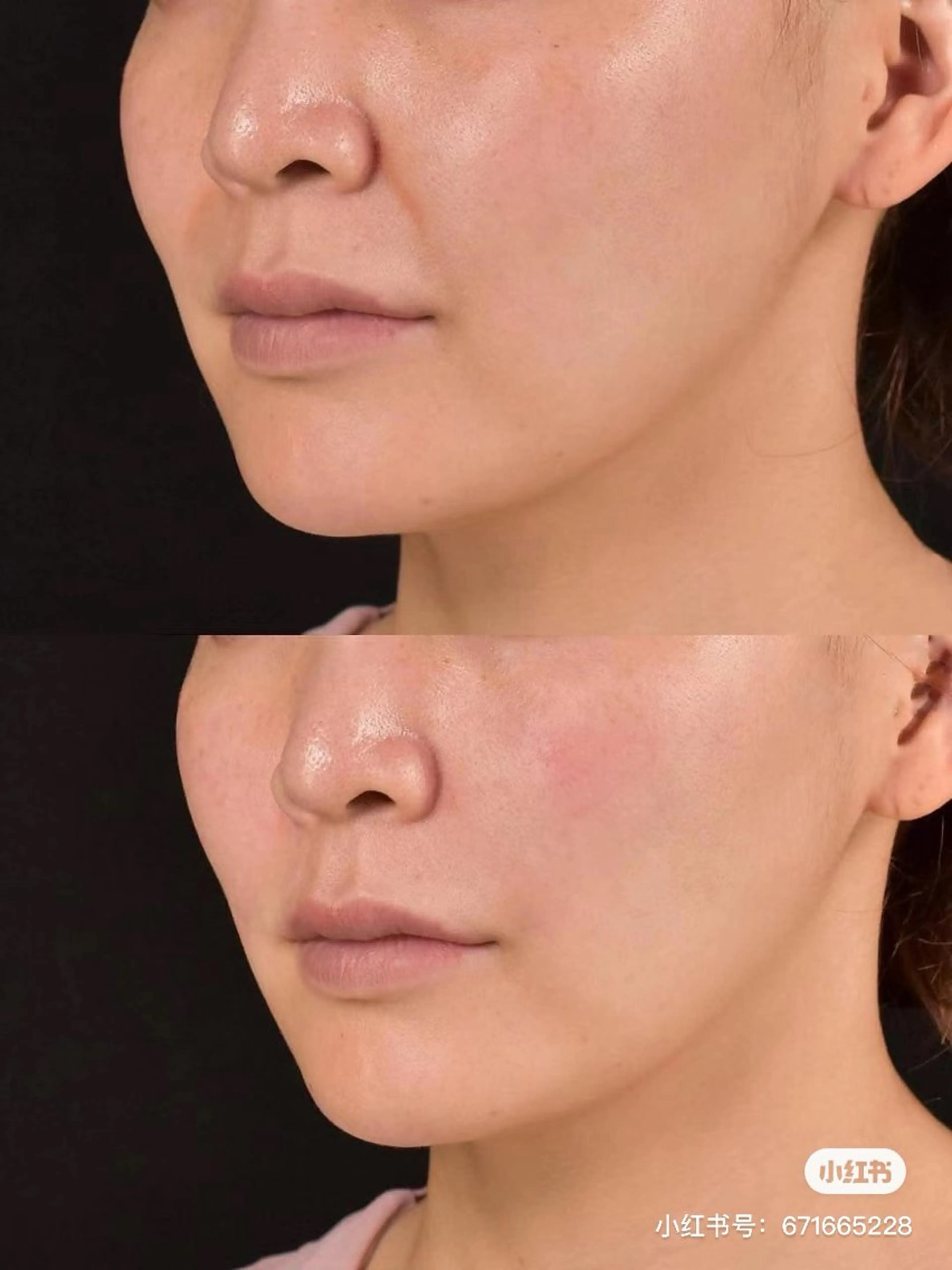 ネイル ブライダルネイル ホワイト エステ aliaハイフ&水光ジェットサロン所属・aliaハーブ水光店 エステティシャン募集のエステ・リラクイメージ