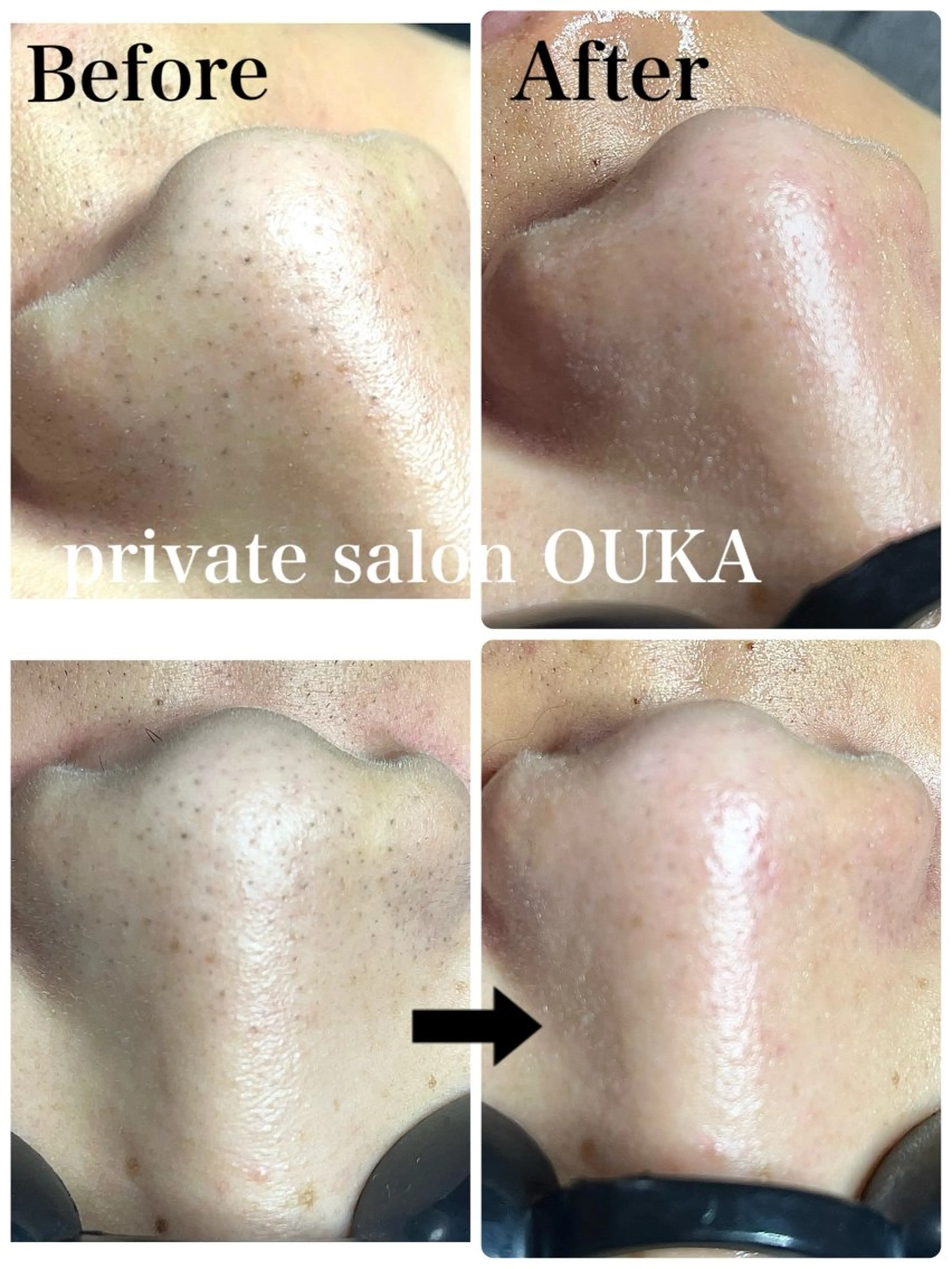 OUKA脱毛 毛穴ケアフェイシャルのエステ・リラクイメージ