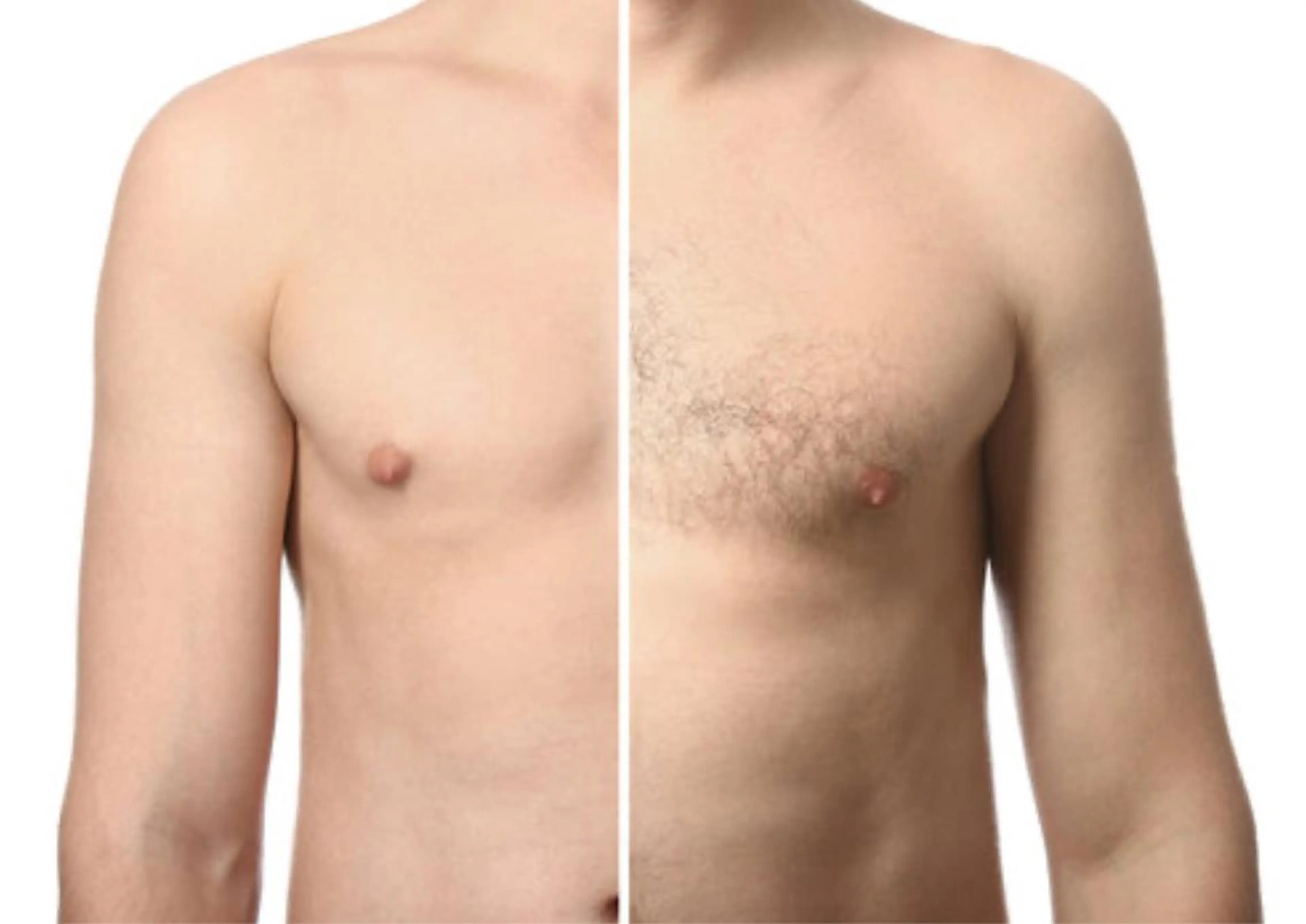 【胴全体 メンズ脱毛】の写真