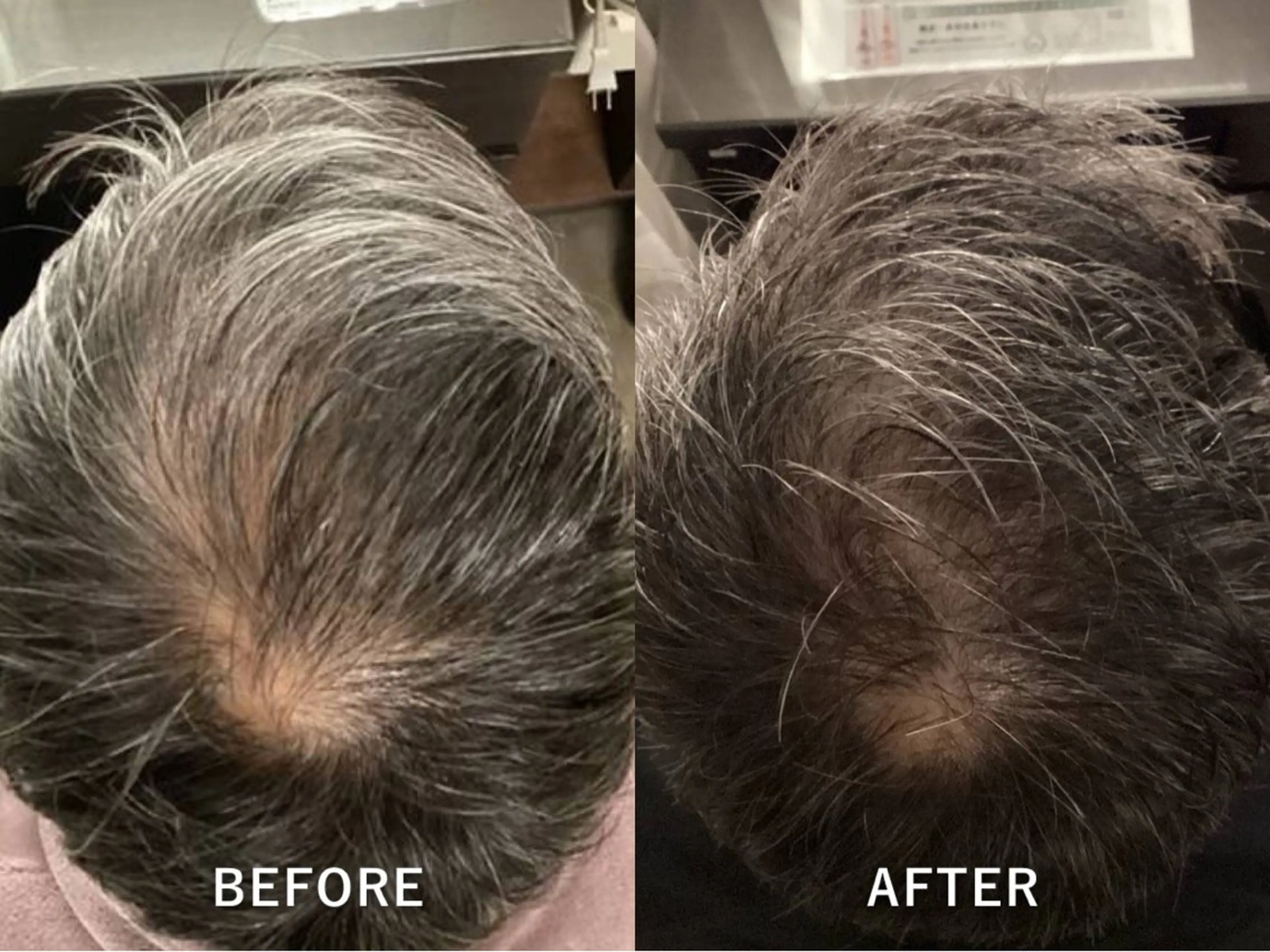 先進育毛プログラムの写真