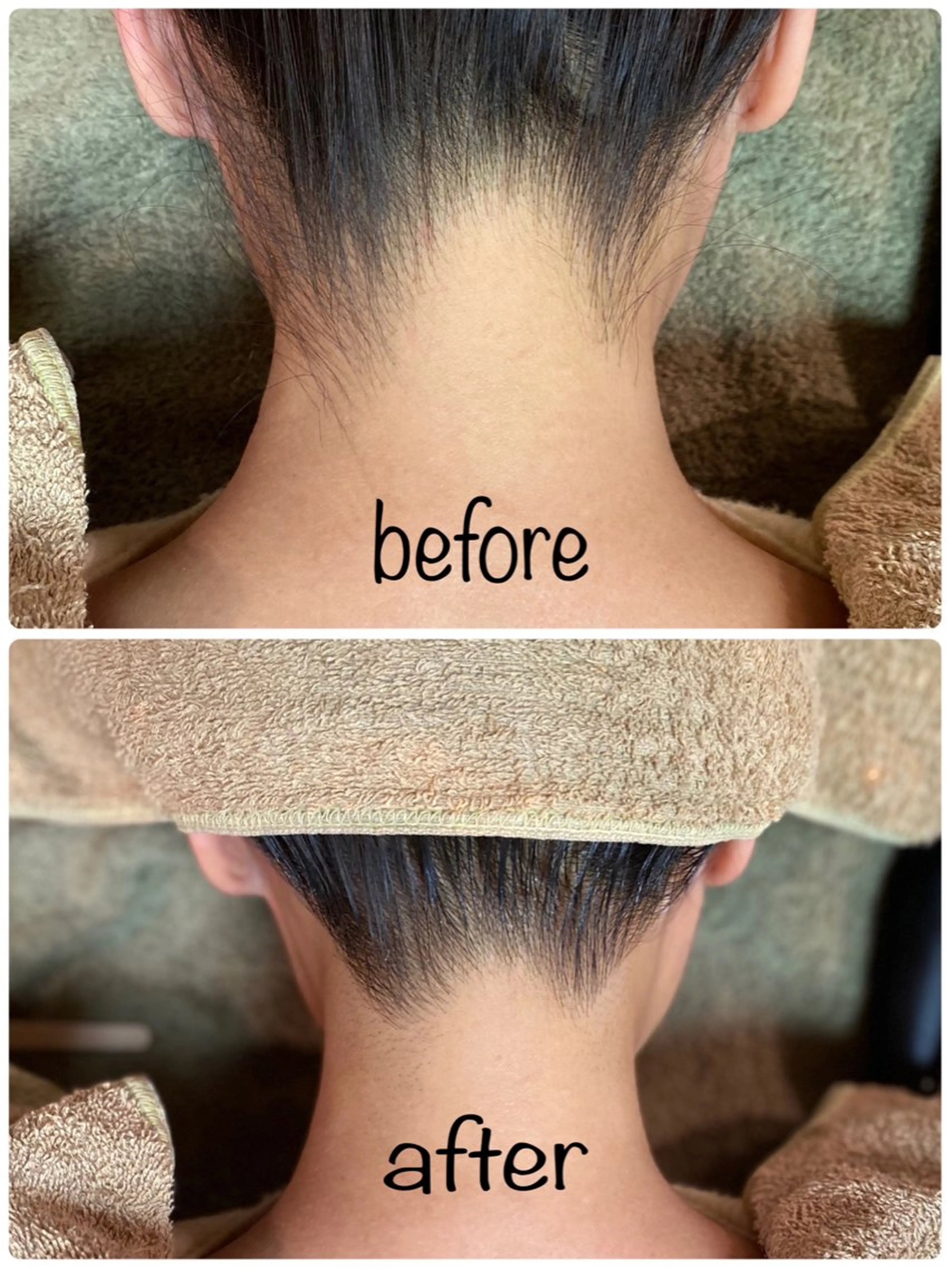 うなじ+背中上【WAX+美容脱毛】の写真