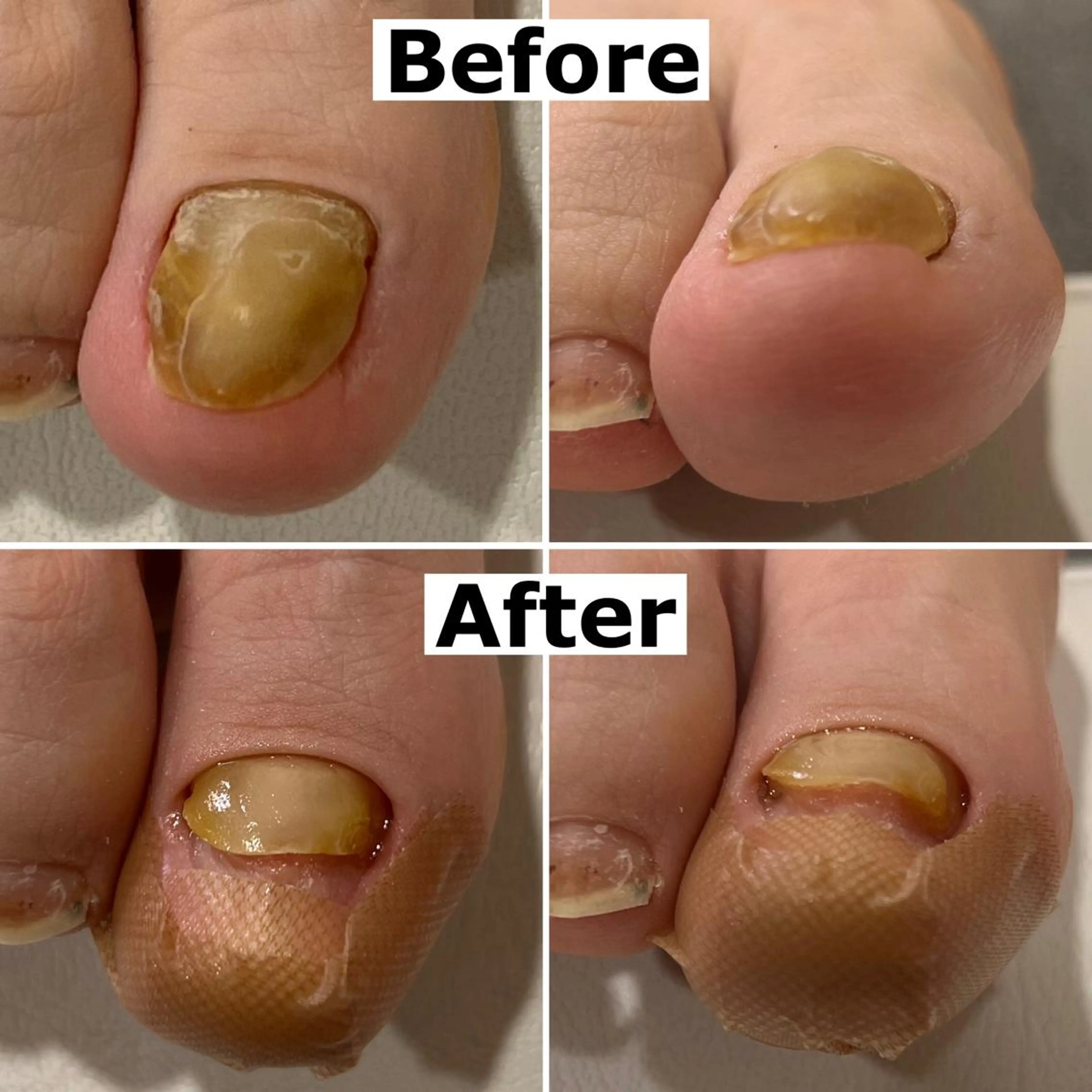 ネイル Mellow nail所属・巻爪無料モデル募集 ✨🦶MEGUMIのネイルデザイン