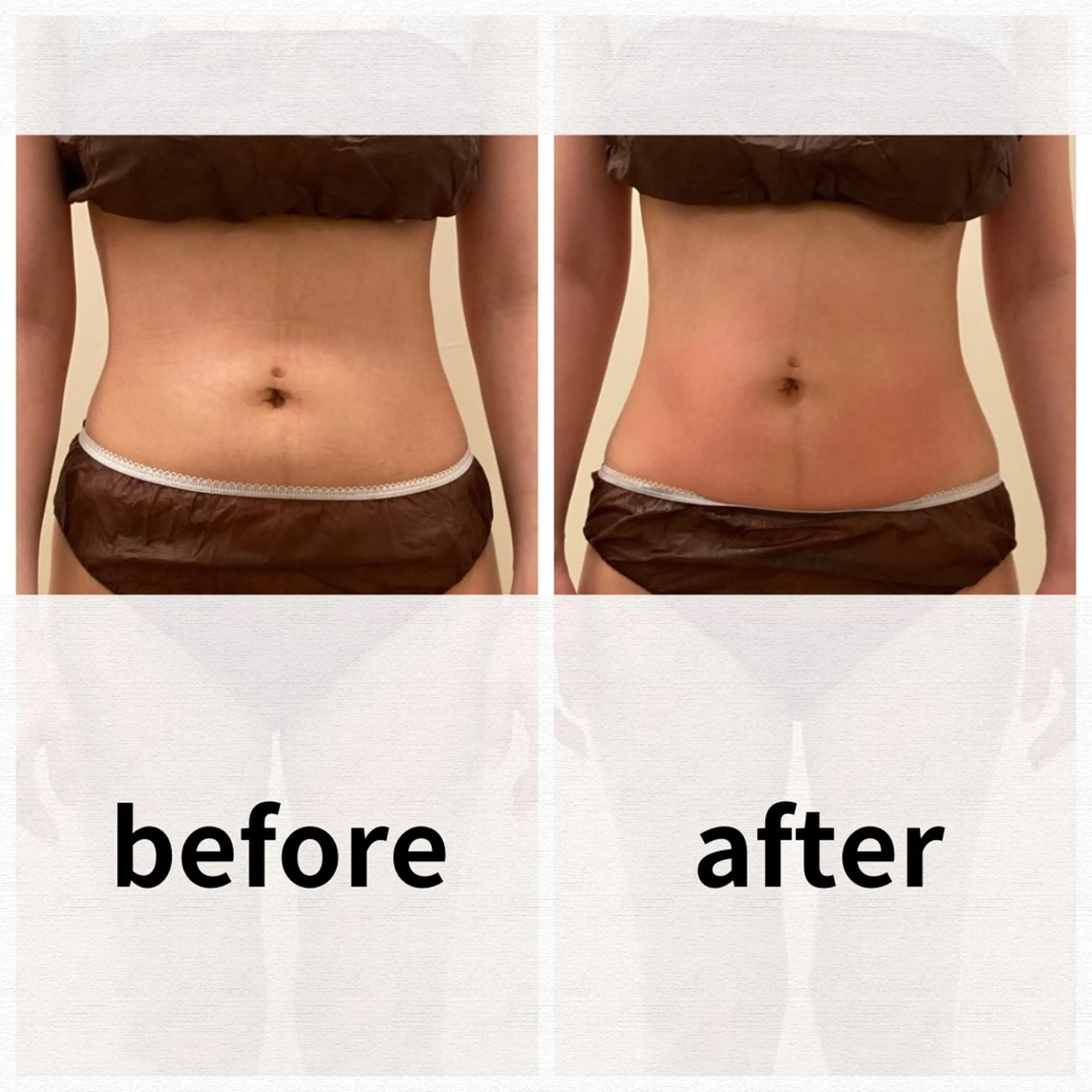 【初回】⦅お腹痩せ⦆ぽっこりお腹にさようなら!自信のくびれを手に入れる❤️🔥【最新痩身機器】の写真