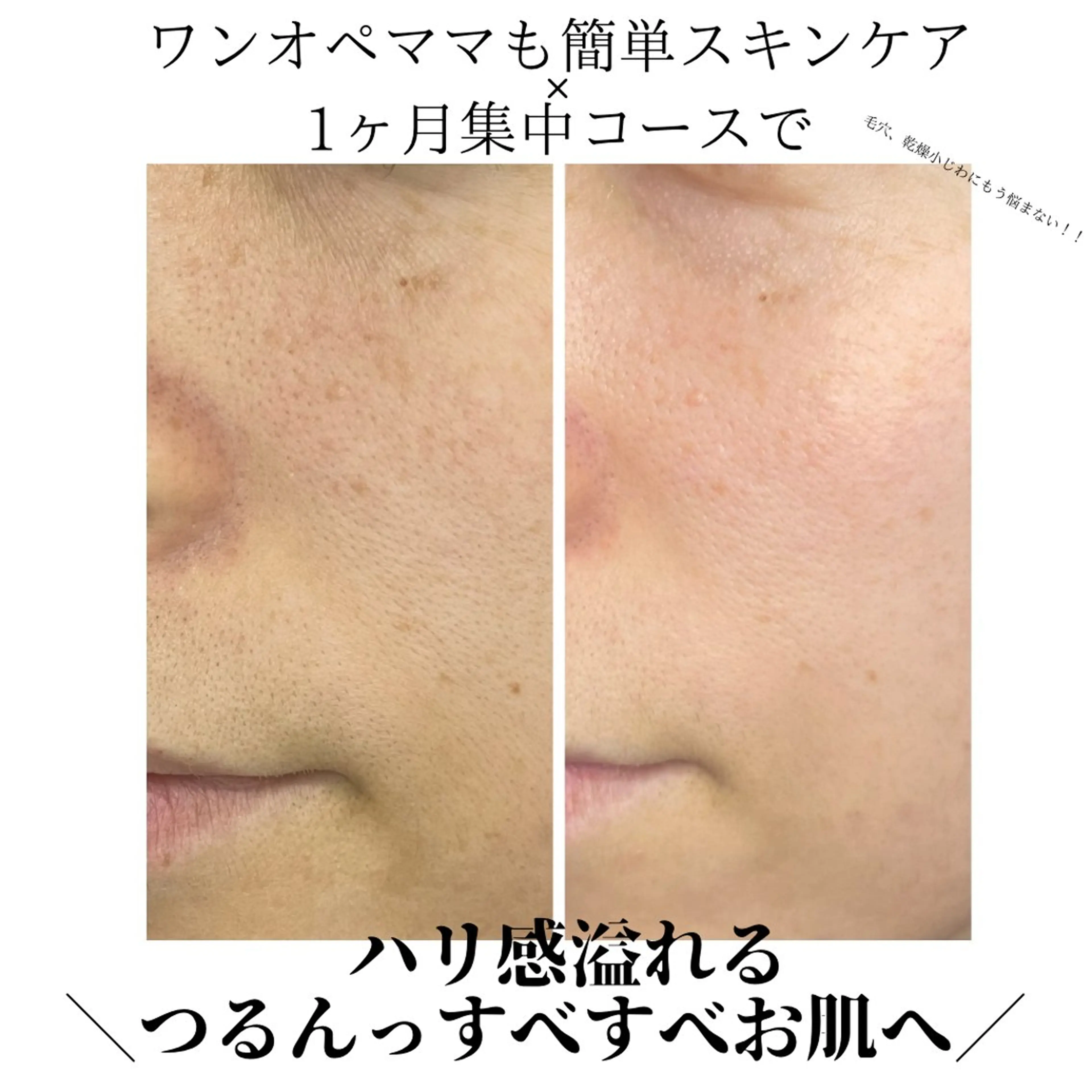 ＼5月残り5名様／破格💥お肌質改善1ヶ月集中キャンペーン✨【1ヶ月5名様限定】の写真