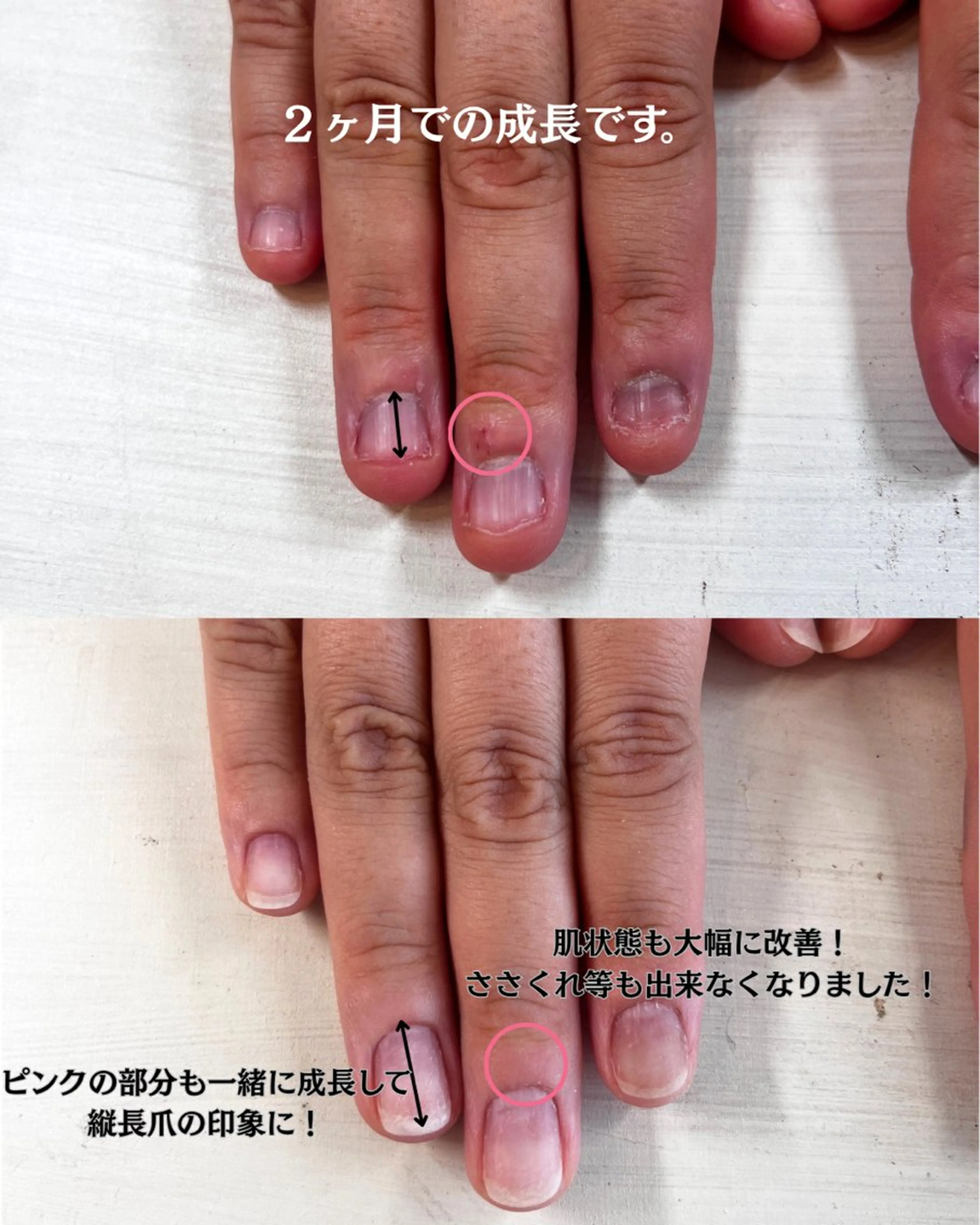 ネイル 深爪矯正・自爪育成 ヴェールリムのネイルデザイン