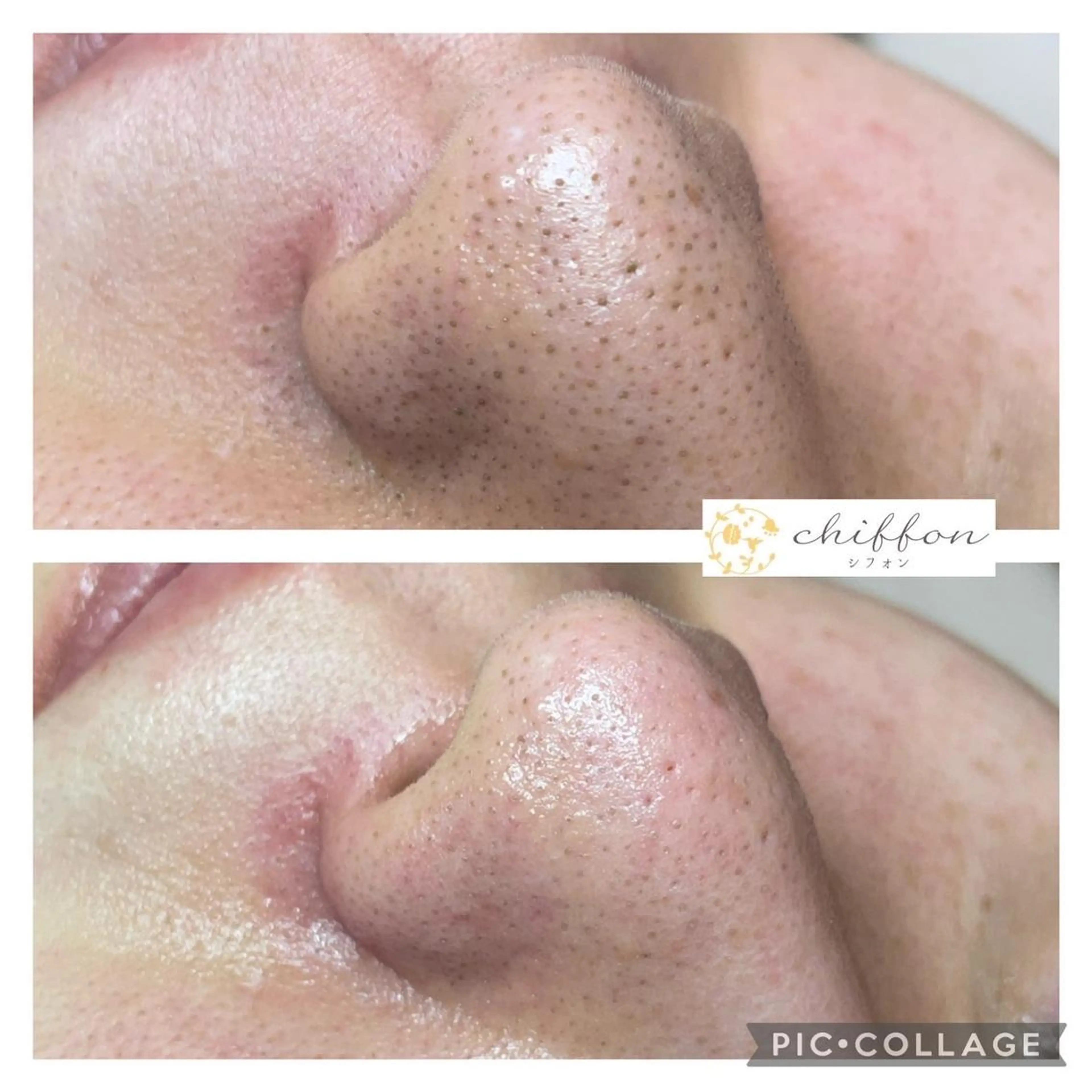 エステ 毛穴黒ずみ改善🥇 ✨シフォン豊田✨のエステ・リラクイメージ