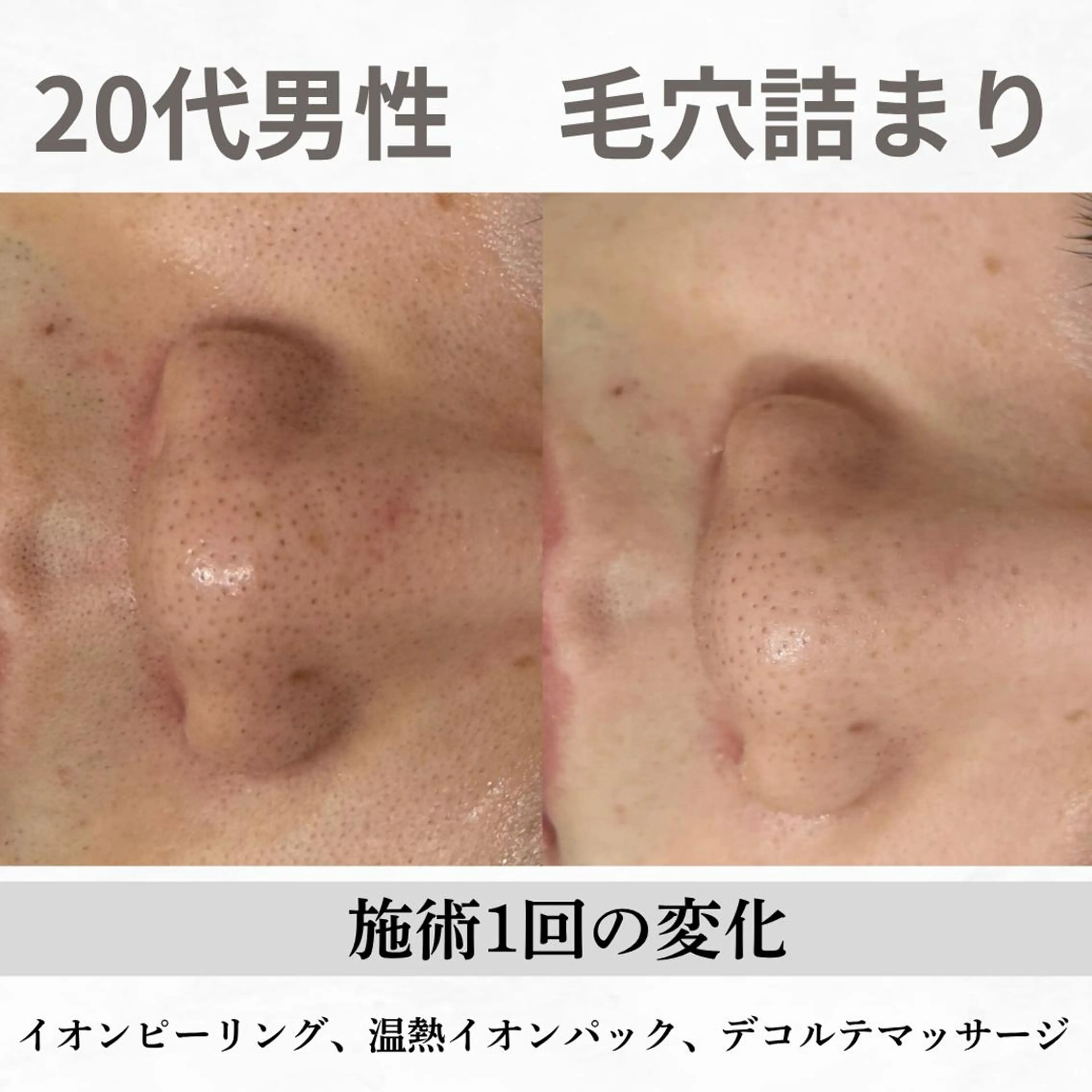重度ニキビ専門🌷 ダウンタイムなしのエステ・リラクイメージ