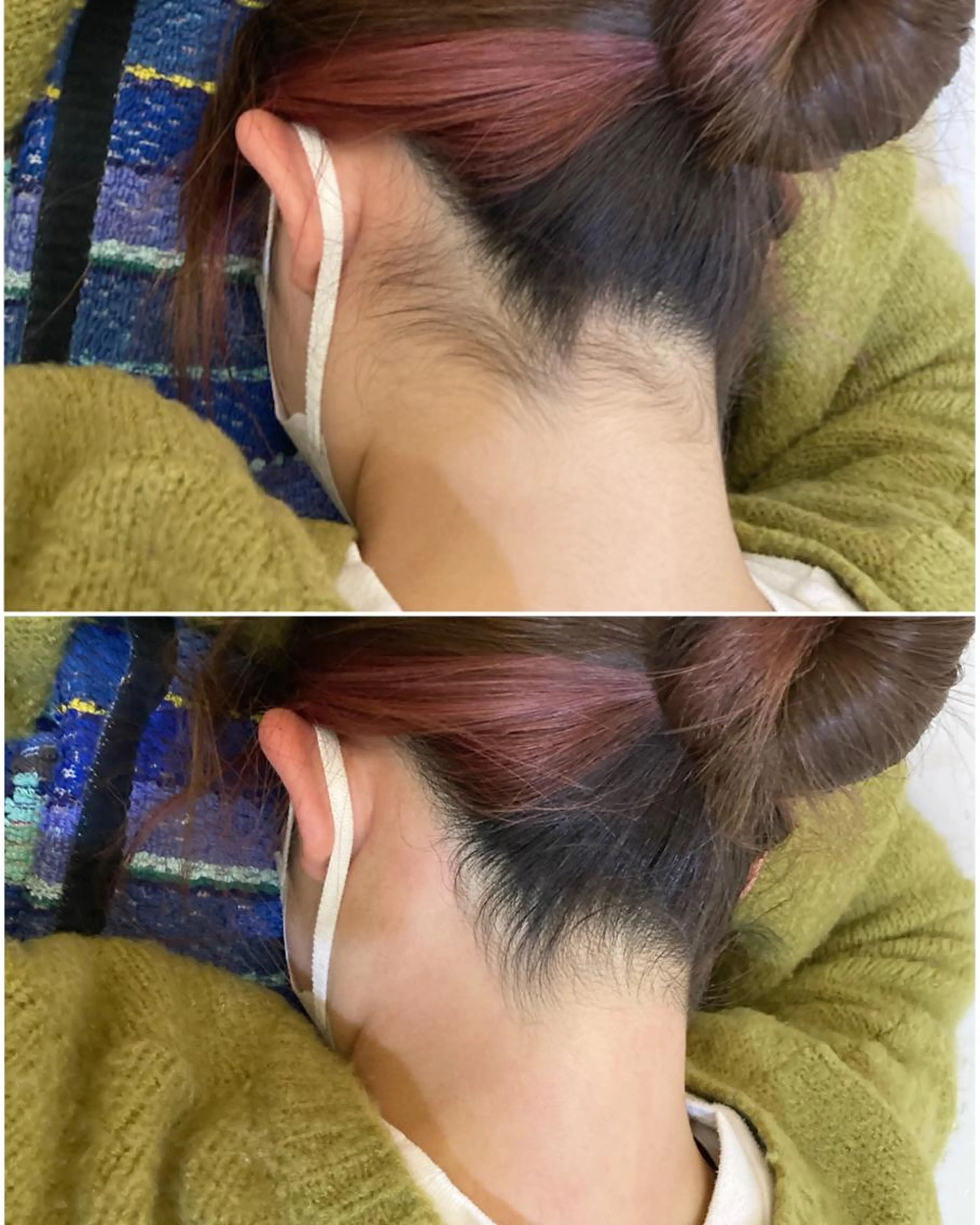 うなじ【WAX+光】ダブル脱毛の写真