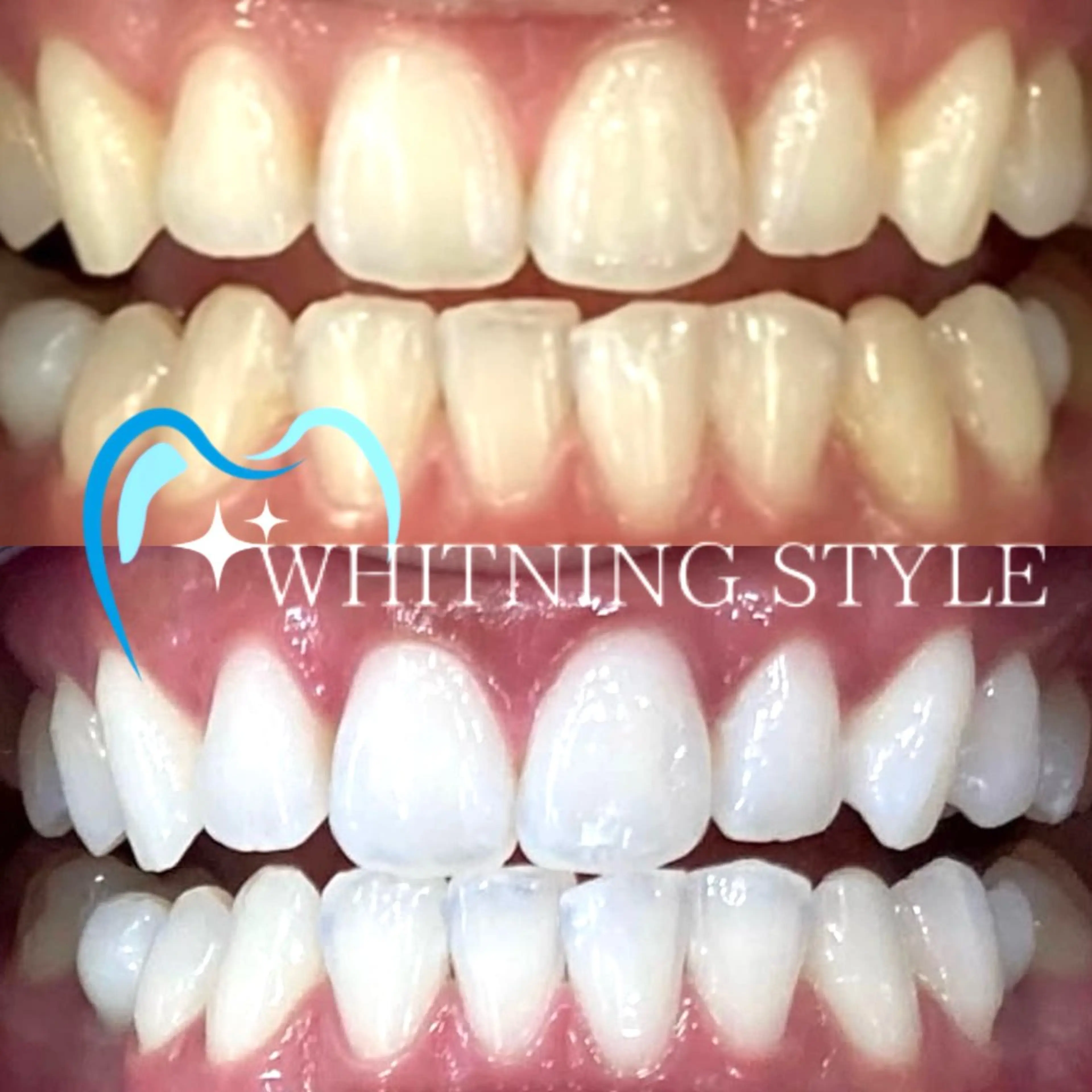 【人気No.1👑】90%の方が選ぶ🔥30分×8来店(1回あたり約4,000円)セルフホワイトニング🦷🔥の写真