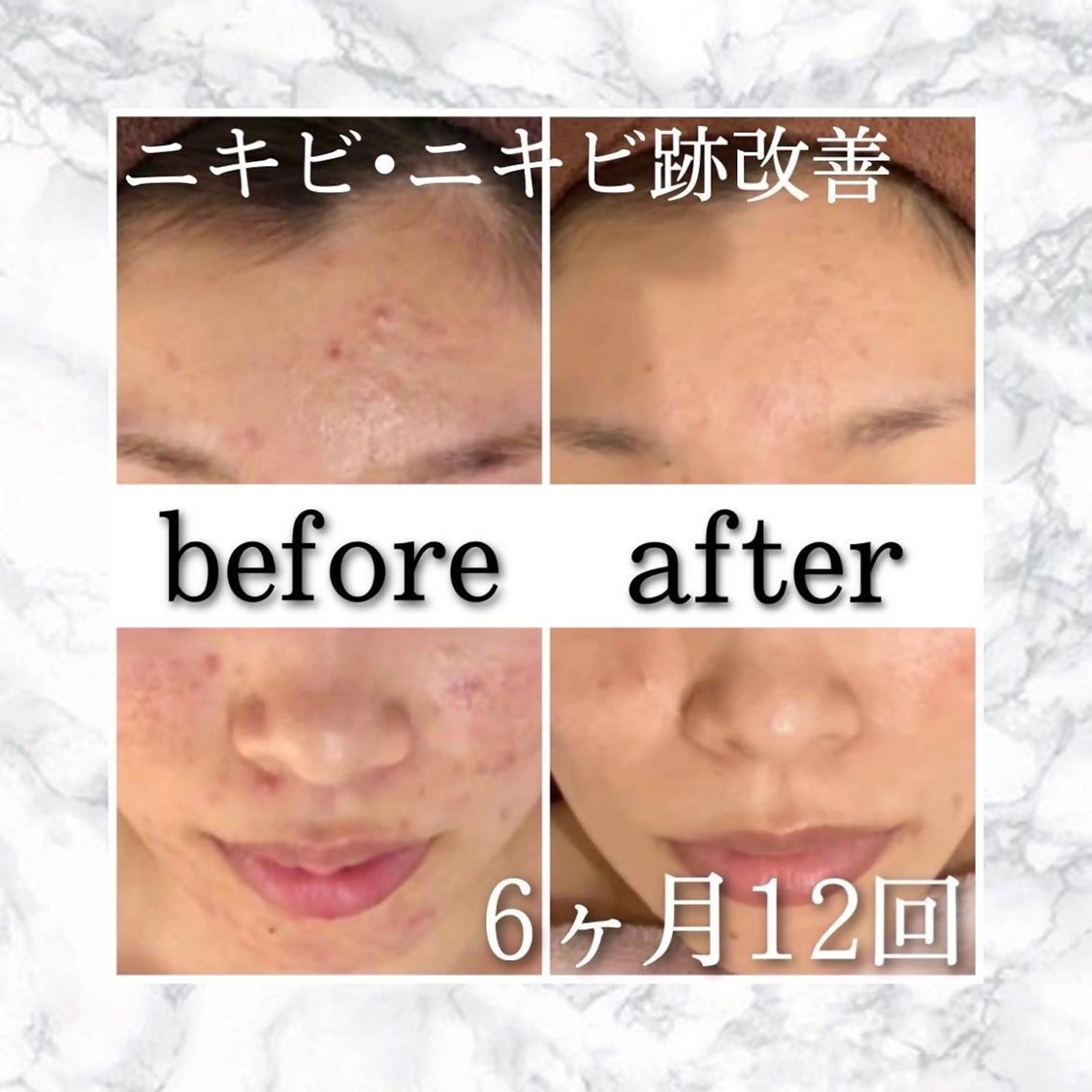 3か月で肌革命👼 ニキビ専門店💫のエステ・リラクイメージ