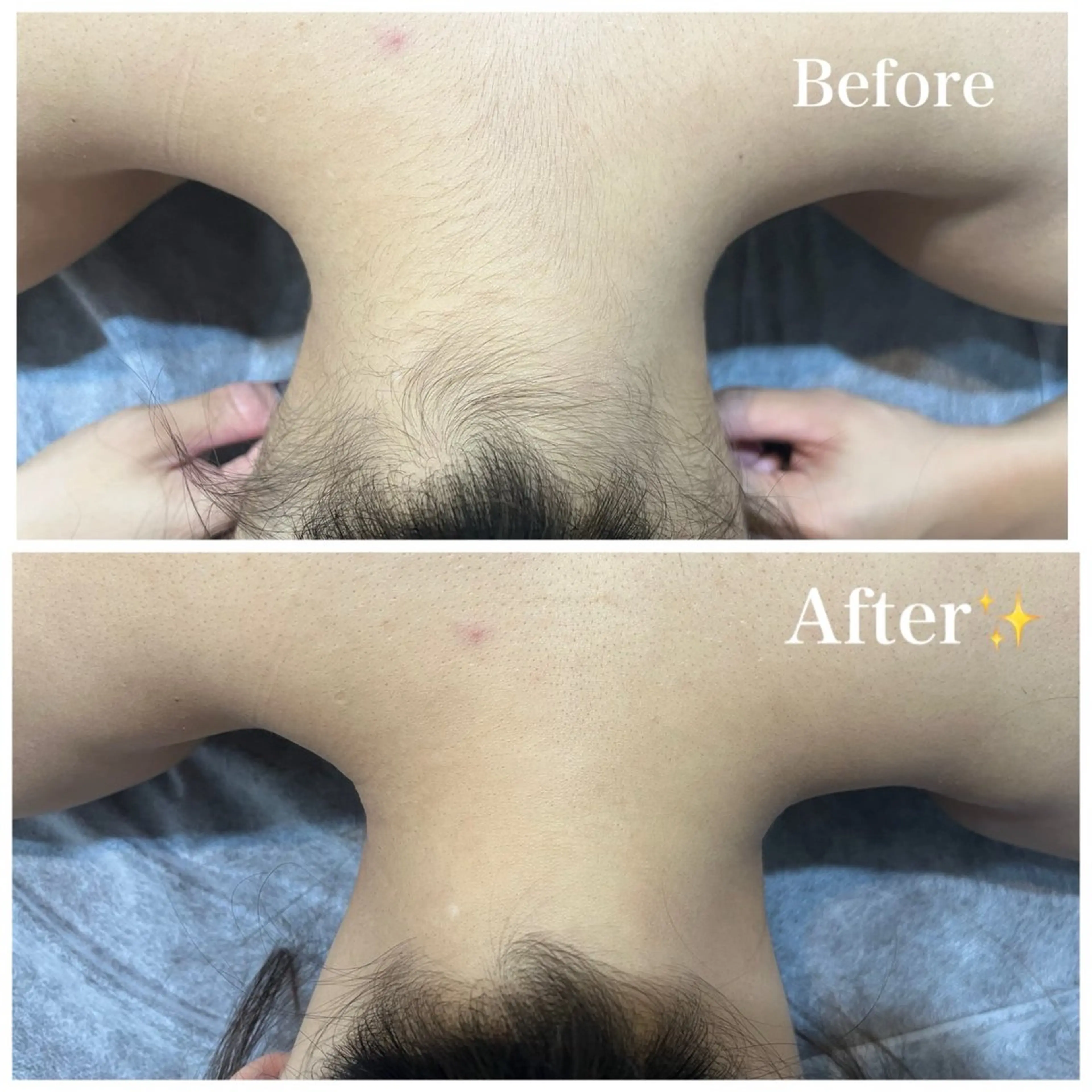 🪞うなじ+背中脱毛🪞の写真