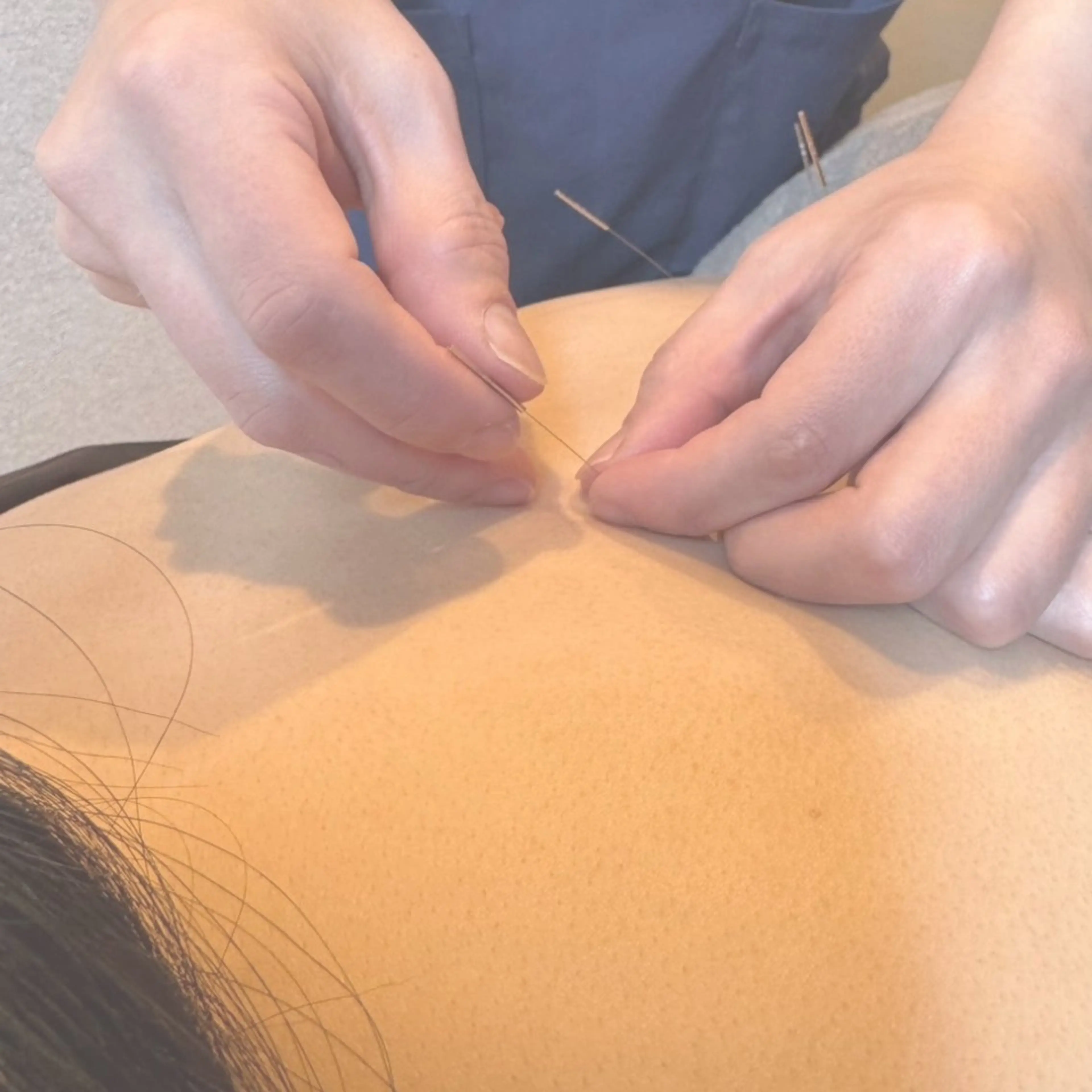 【初回限定】鍼灸施術の写真