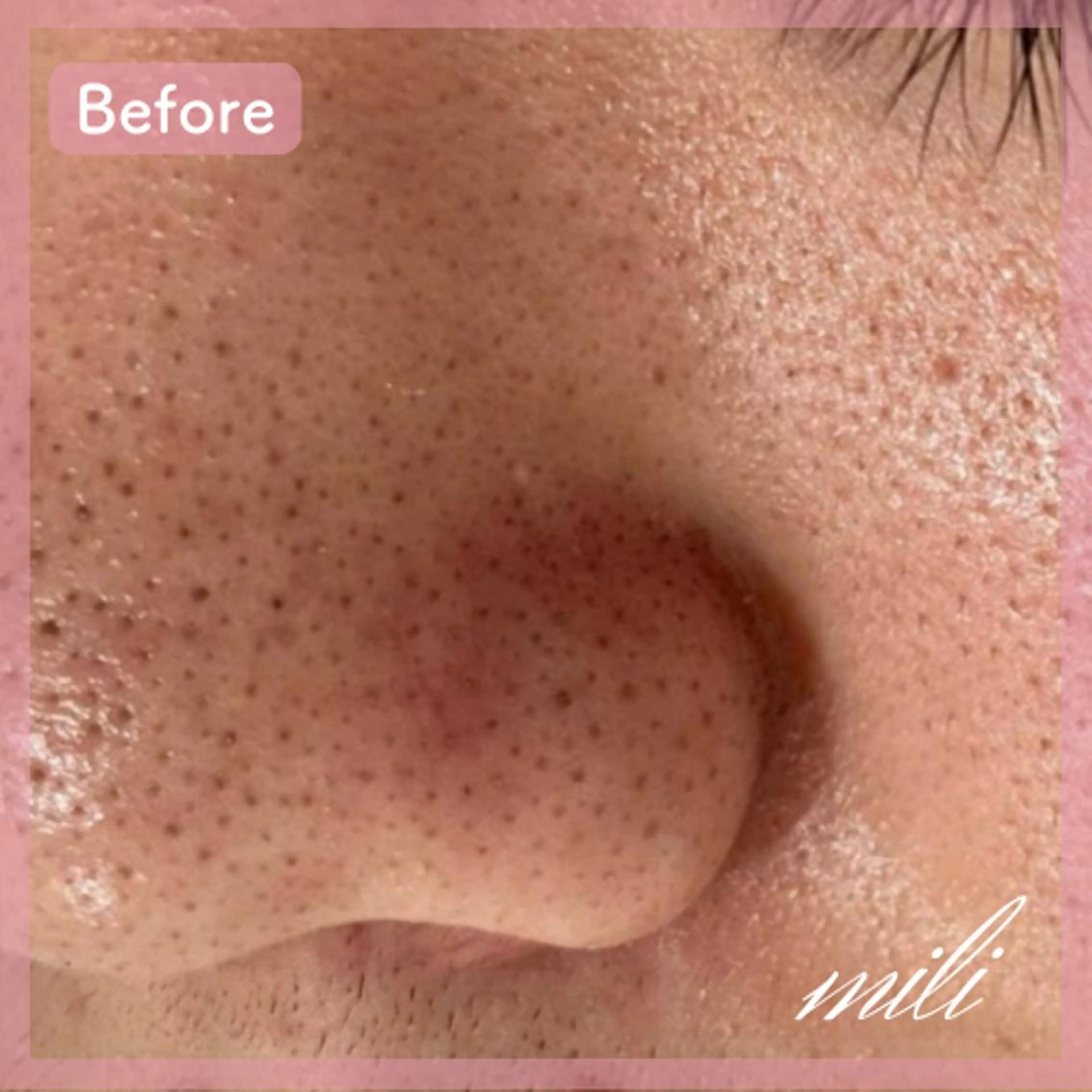 エステ 【毛穴ケア専門店✨】 mili 須藤歩華のエステ・リラクイメージ