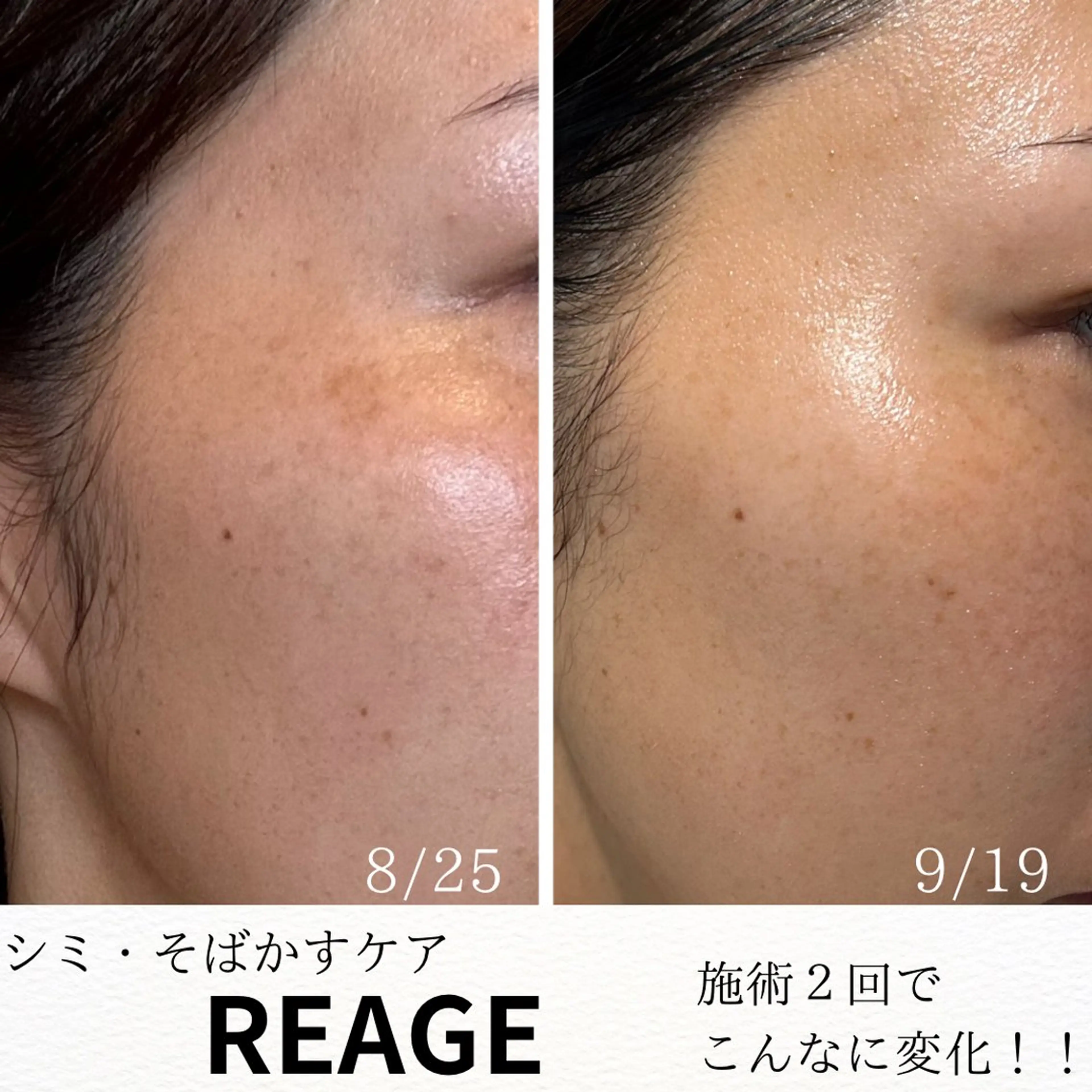 【シミ難民の私を救った】　　　　　　　　　　　　　　　　　　感動の‼︎シミ、そばかす改善メニューの写真