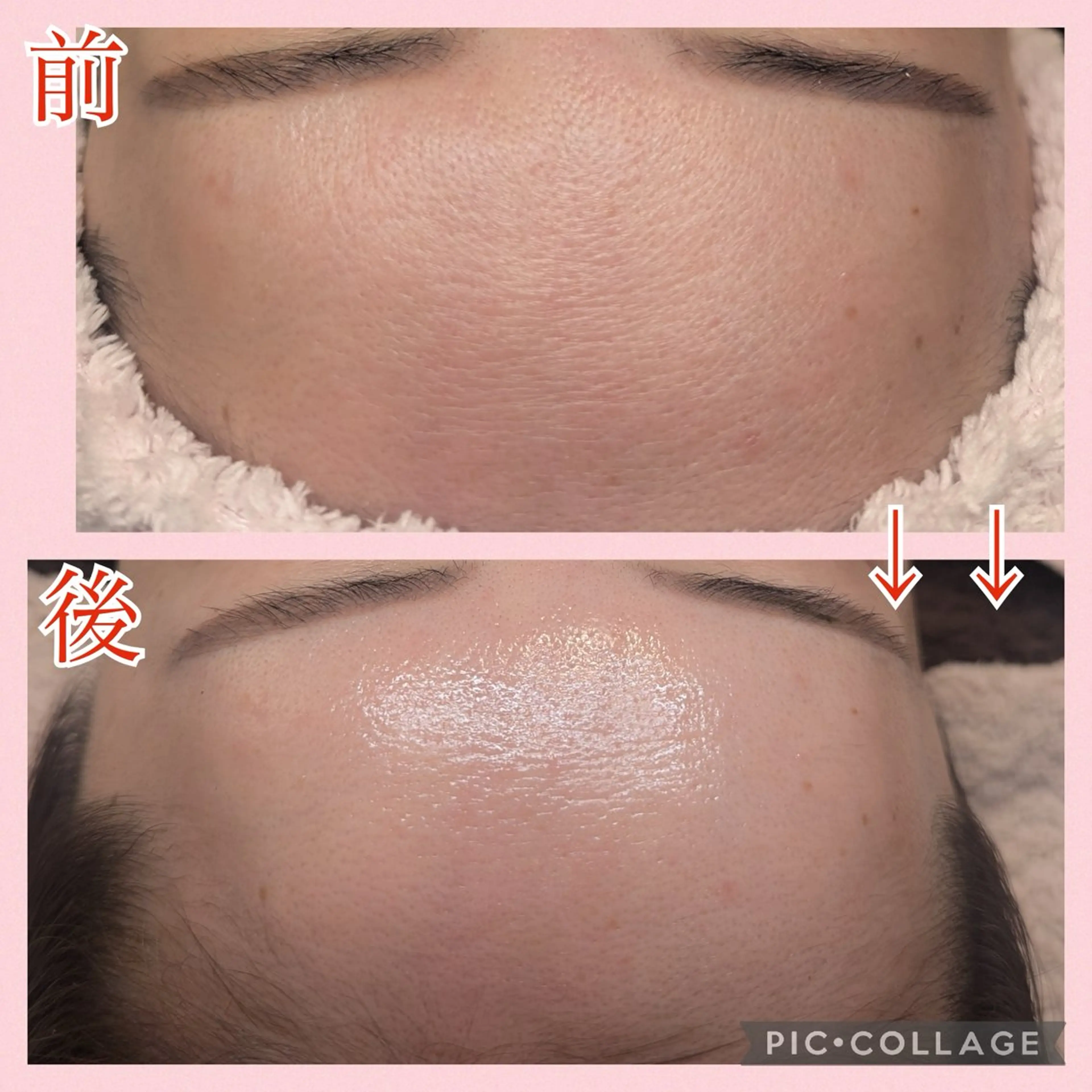 【ミニモREVIハーブピーリング】"ごわつきざらつき解消"通常価格¥11000→¥7500の写真