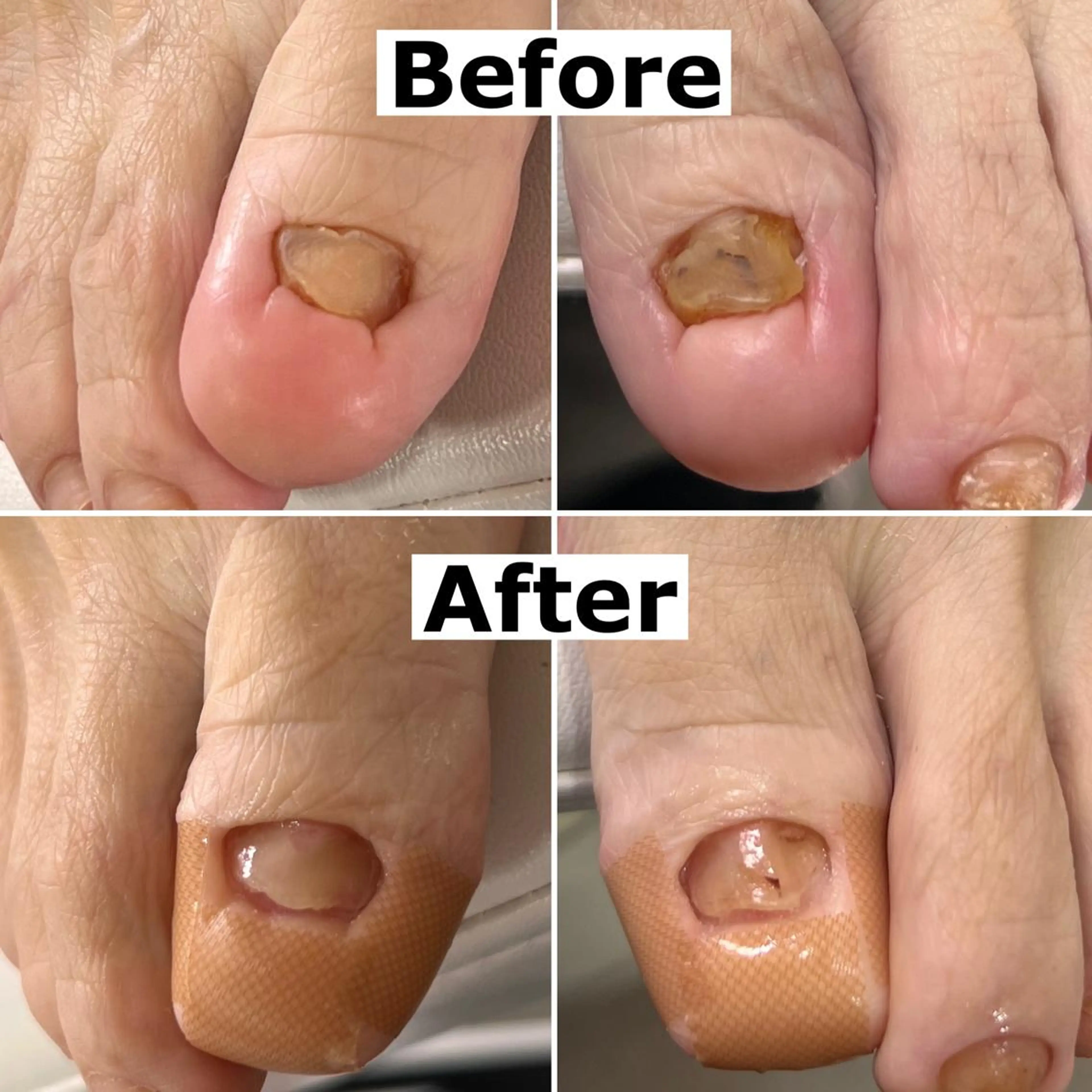 ネイル 巻爪無料モデル募集 ✨🦶MEGUMIのネイルデザイン