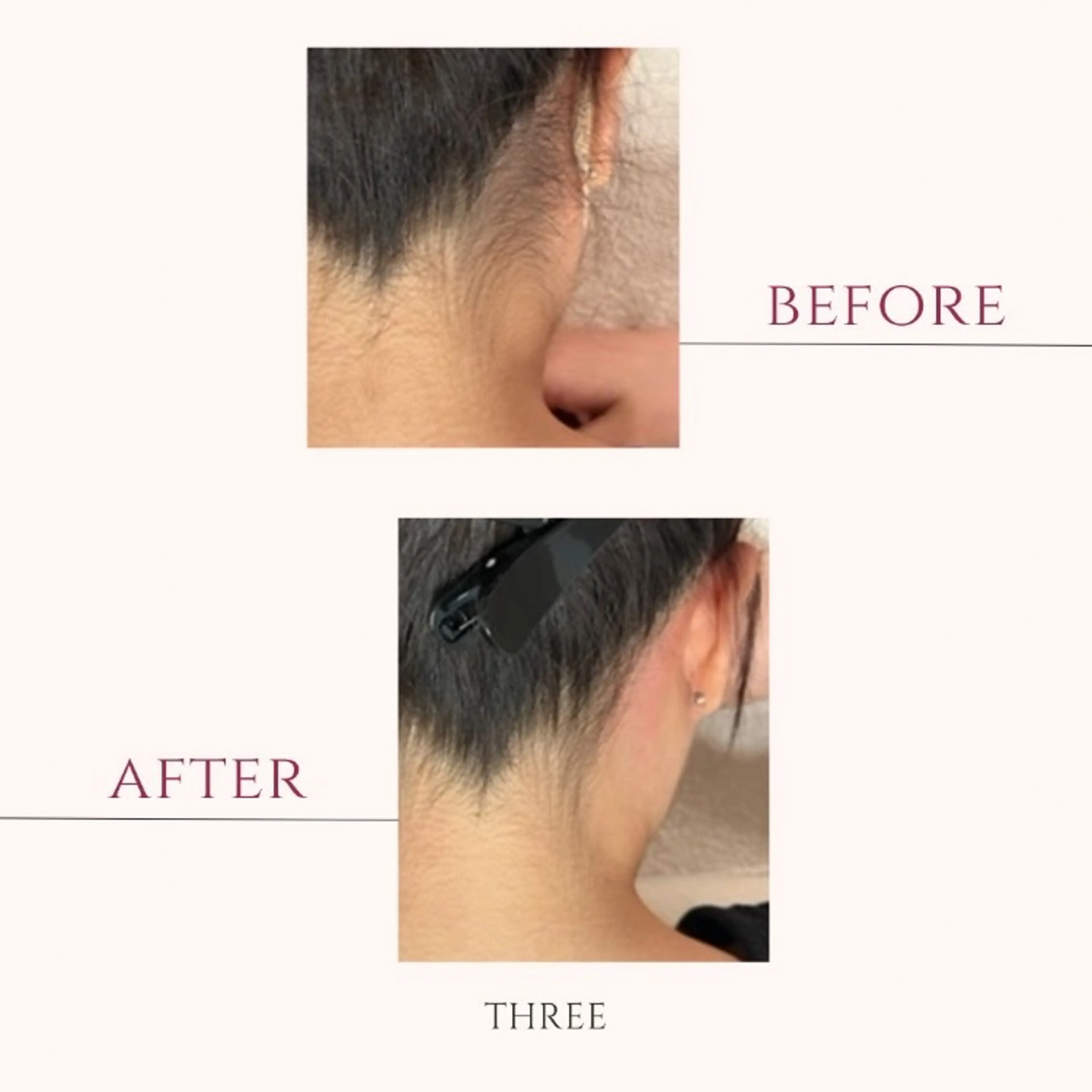 メンズ キッズ 脱毛 福留 千春のその他イメージ