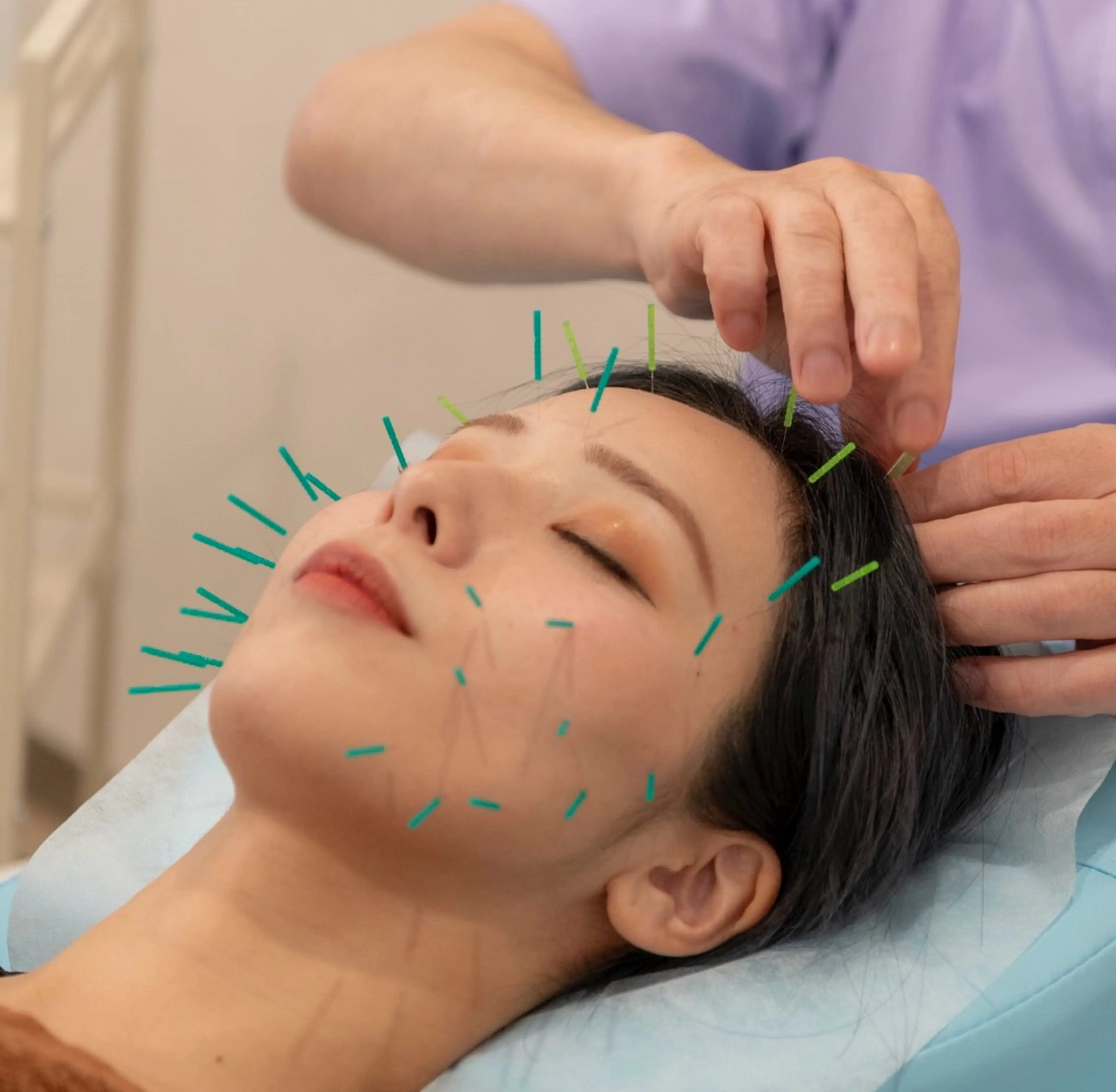 【女性大人気No.1✨】　リフトアップやむくみたるみに◎美容鍼60分の写真