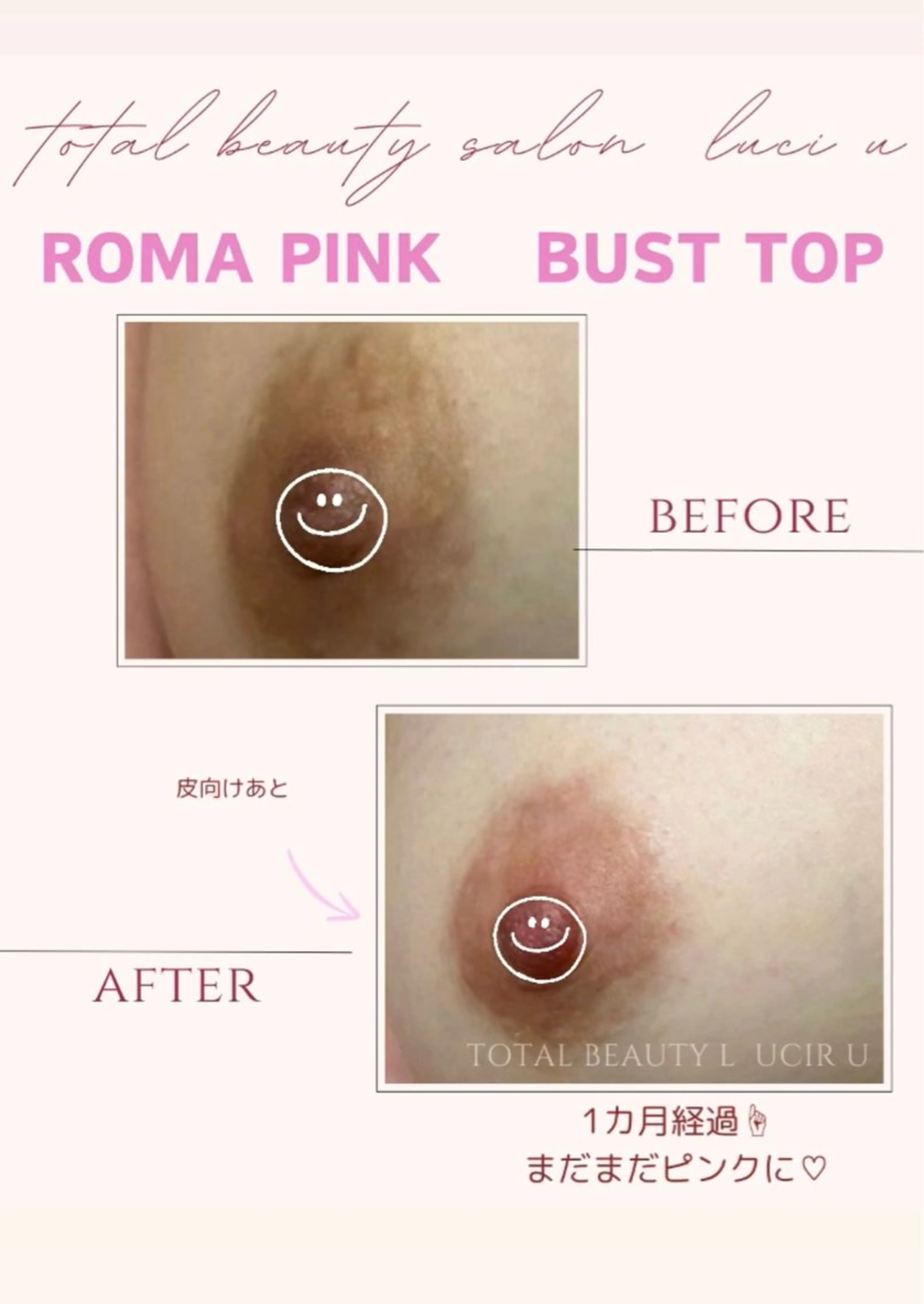 3月中40%OFF更に小顔矯正特典付きバストトップ(ニップル)メラニン除去の写真