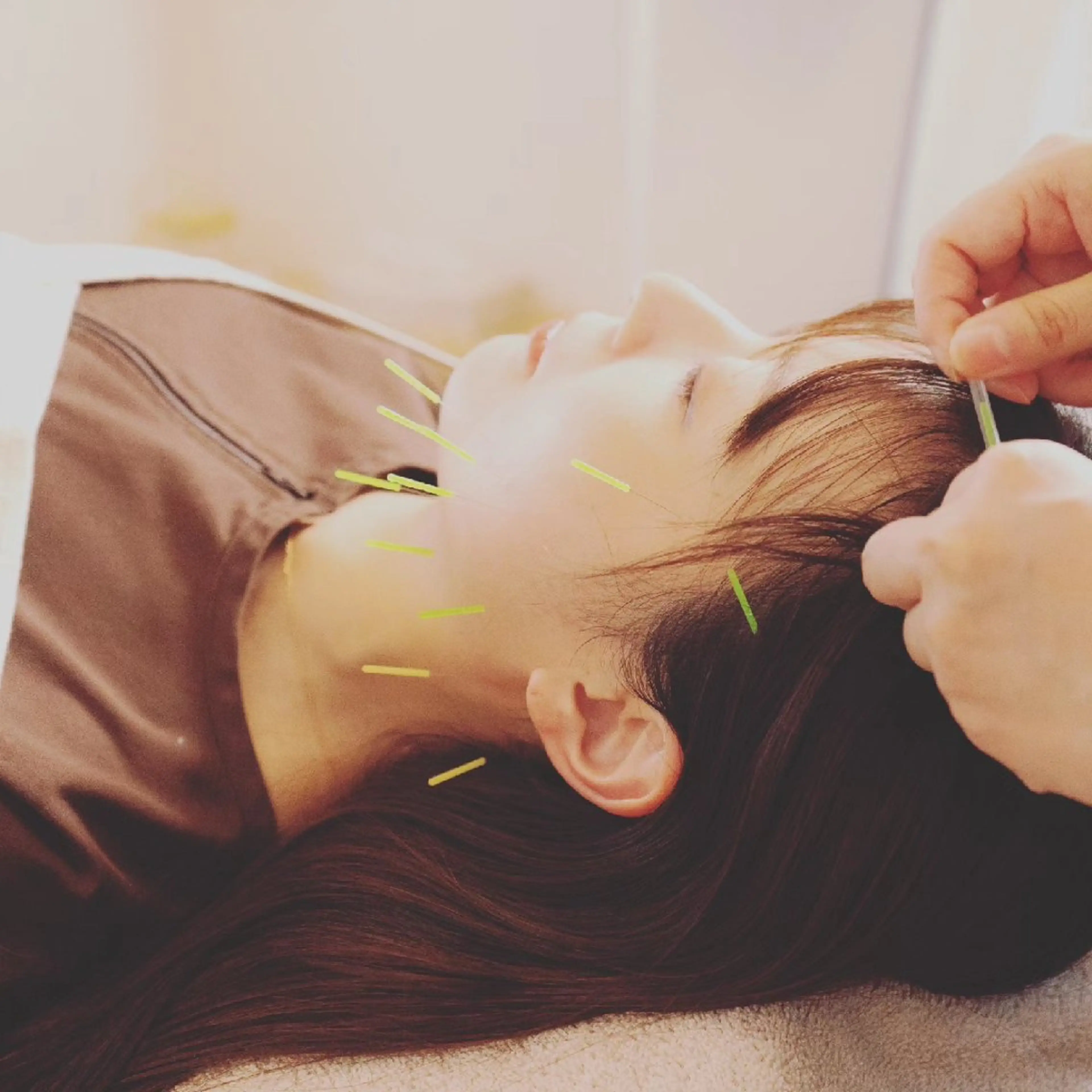 エステ リラク 即効⚡小顔美容鍼🪡 むくみたるみ脂肪解消のエステ・リラクイメージ