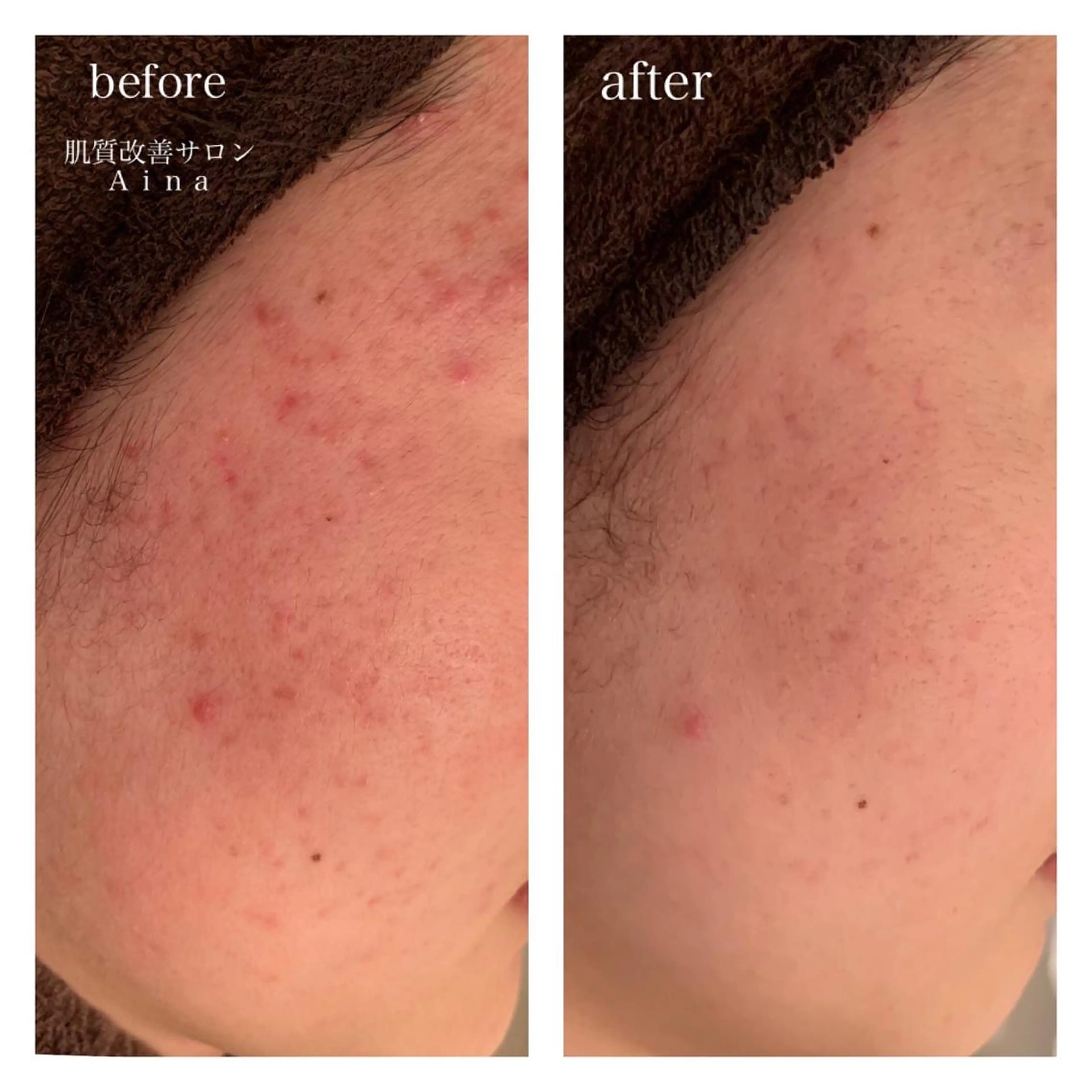 ミディアム カラー パーマ ヘアアレンジ メンズ キッズ ネイル マツエク・マツパ 赤色 ニキビ跡専門サロン Ａｉｎａのエステ・リラクイメージ