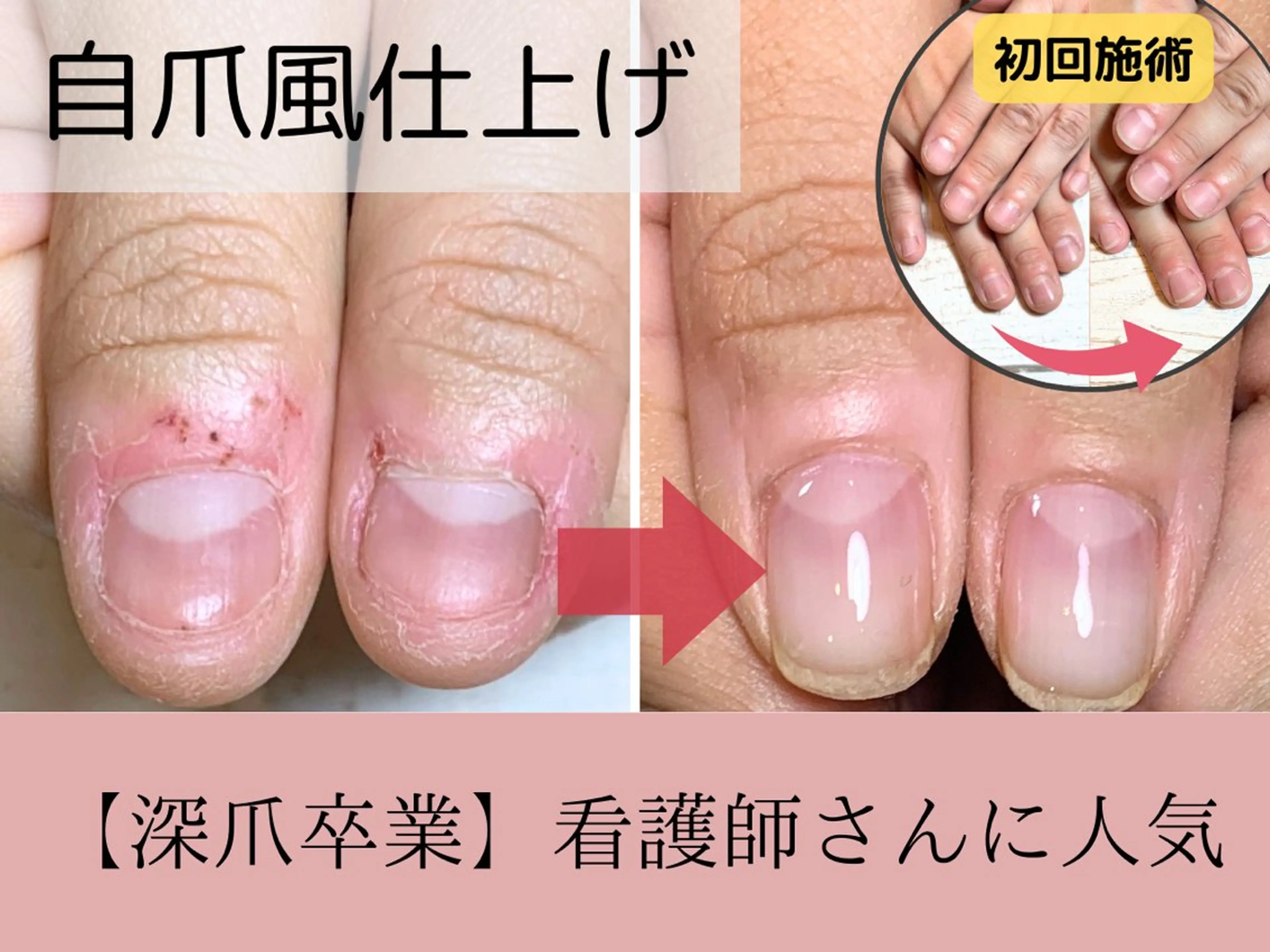 ネイル 深爪矯正・自爪育成 ネイルサロンアモここのネイルデザイン