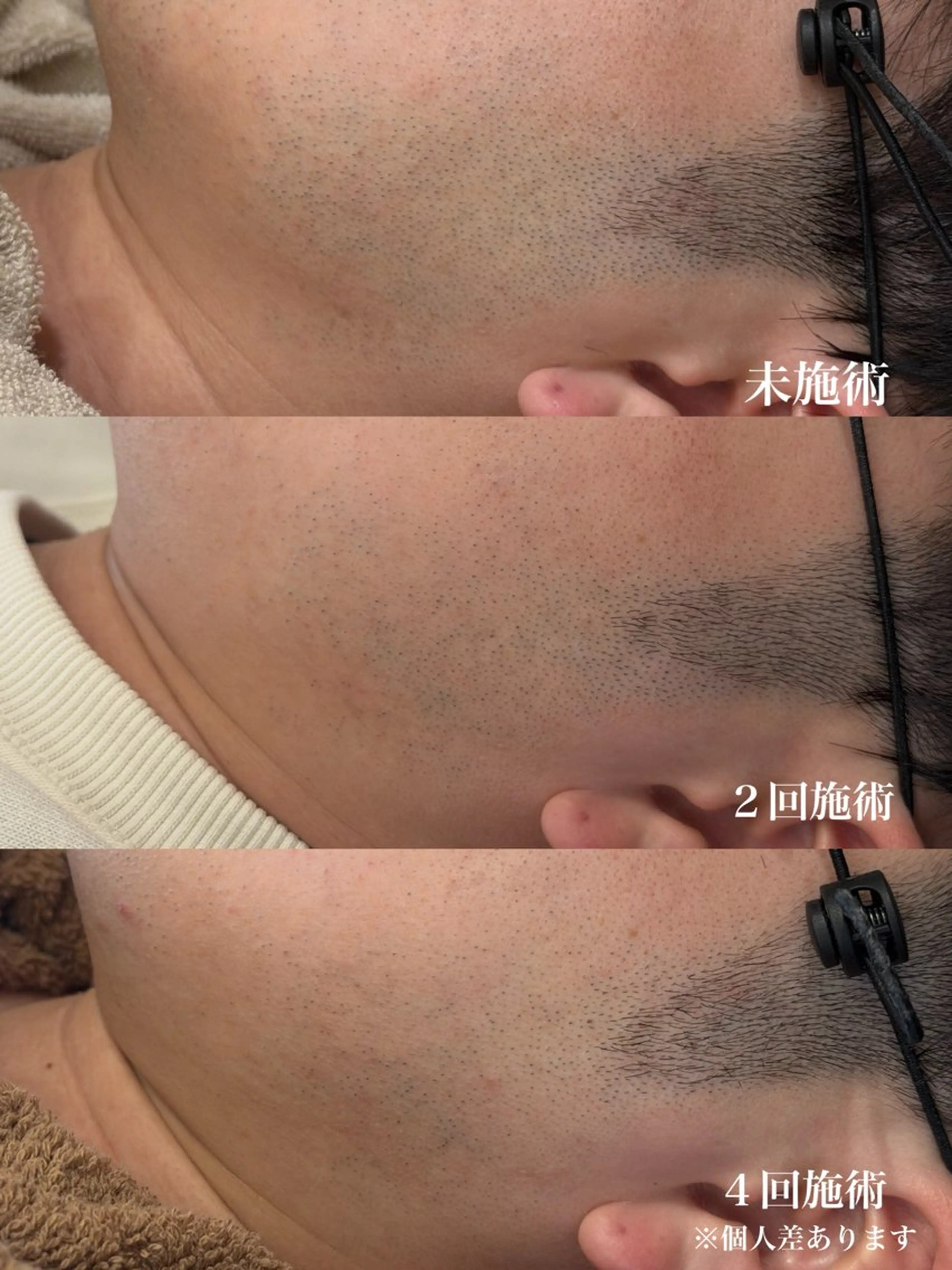 メンズ 脱毛 muumo まりののエステ・リラクイメージ